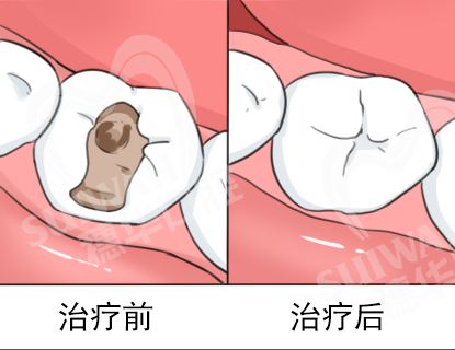 2023-4-4条漫-
复合树脂.png
