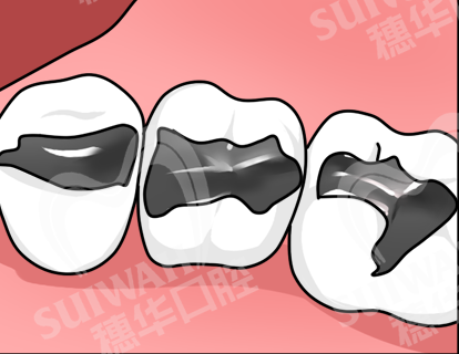 2023-4-4条漫-
银汞合金.png