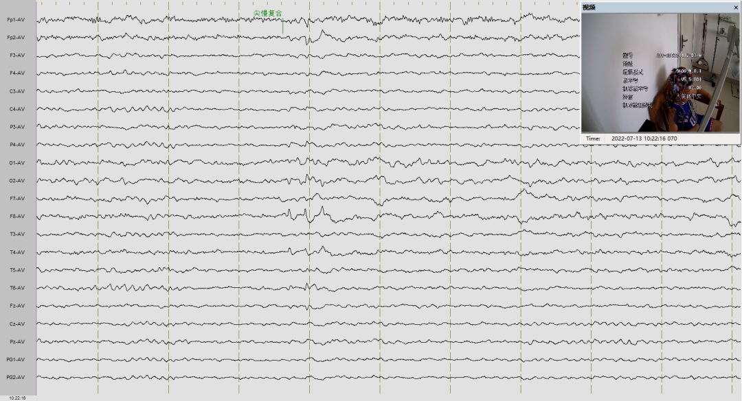 16导脑电图怎么放置长程多导视频脑电图准确捕捉“异常波”的蛛丝马迹 ----- 潢川县人民医院服务能力提升系列报道_https://www.jmylbn.com_新闻资讯_第4张