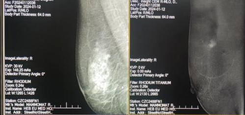 数字化摄影是什么检查【高质量发展篇·卓越筑新】邯郸首例！河北工程大学附属医院影像科顺利开展对比增强双能数字化乳腺X线摄影（CEDM）检查_https://www.jmylbn.com_新闻资讯_第1张