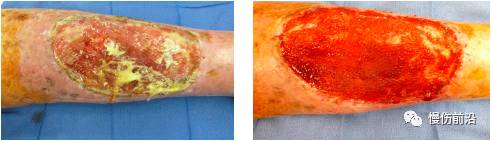 抗菌清创敷料有什么用基础知识：清创在伤口愈合中的重要作用_https://www.jmylbn.com_新闻资讯_第1张