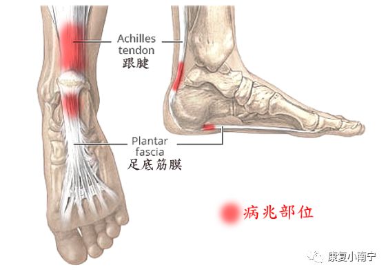 什么是阿基里斯肌腱炎 视野之都 微信公众号文章阅读 Wemp