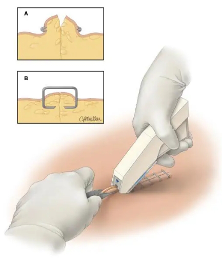 为什么要用皮钉缝合科普电台｜你听过钉皮机吗？_https://www.jmylbn.com_新闻资讯_第11张