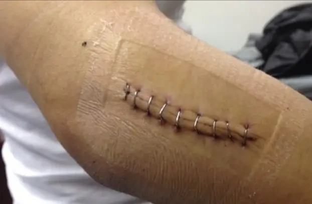 为什么要用皮钉缝合科普电台｜你听过钉皮机吗？_https://www.jmylbn.com_新闻资讯_第9张