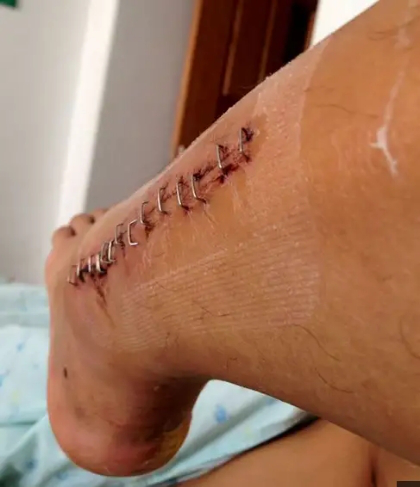 为什么要用皮钉缝合科普电台｜你听过钉皮机吗？_https://www.jmylbn.com_新闻资讯_第5张