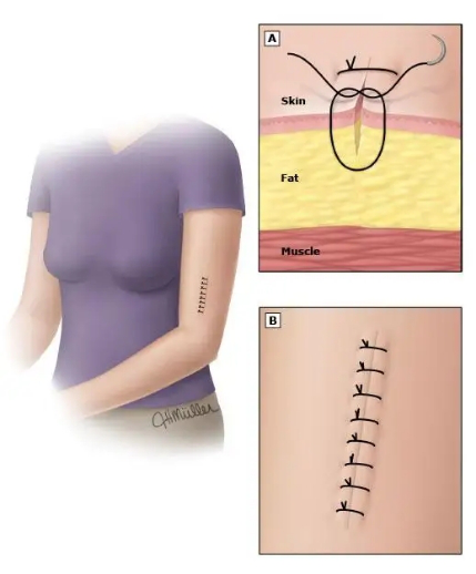 为什么要用皮钉缝合科普电台｜你听过钉皮机吗？_https://www.jmylbn.com_新闻资讯_第4张