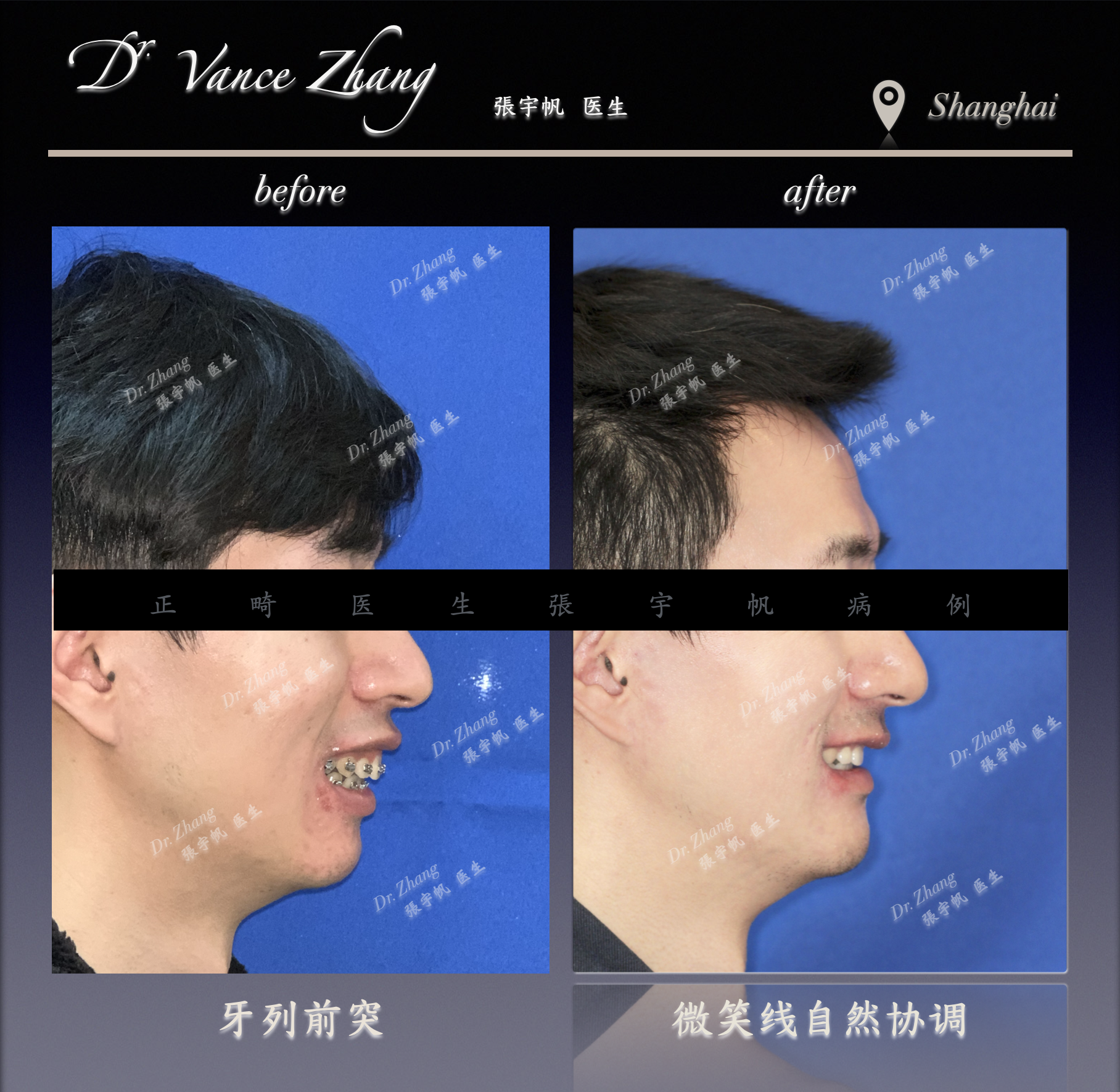 骨性嘴突二次矫正正式病例贴图7