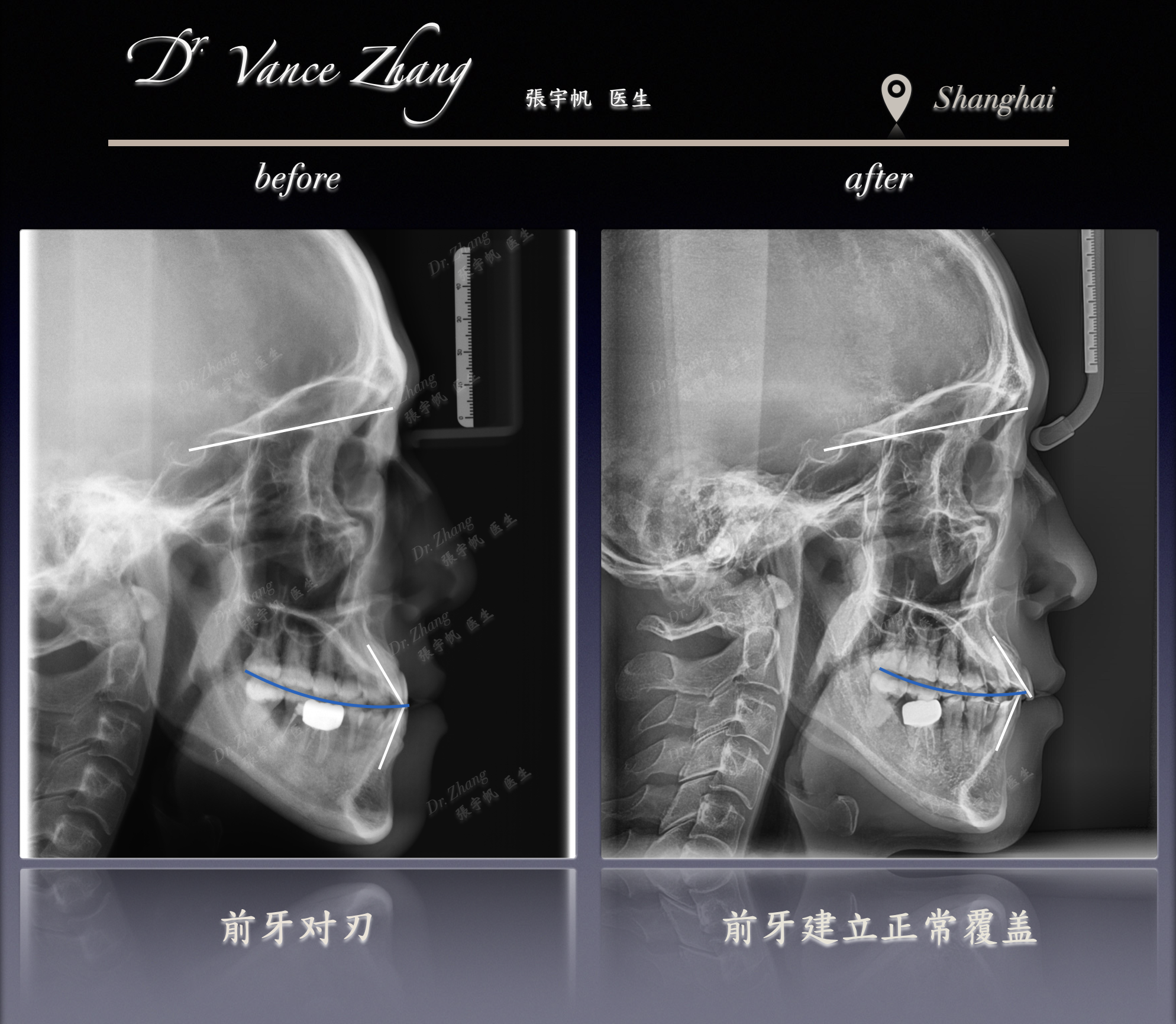 一例成人骨性III类偏颌合并反𬌗病例正式病例贴图15