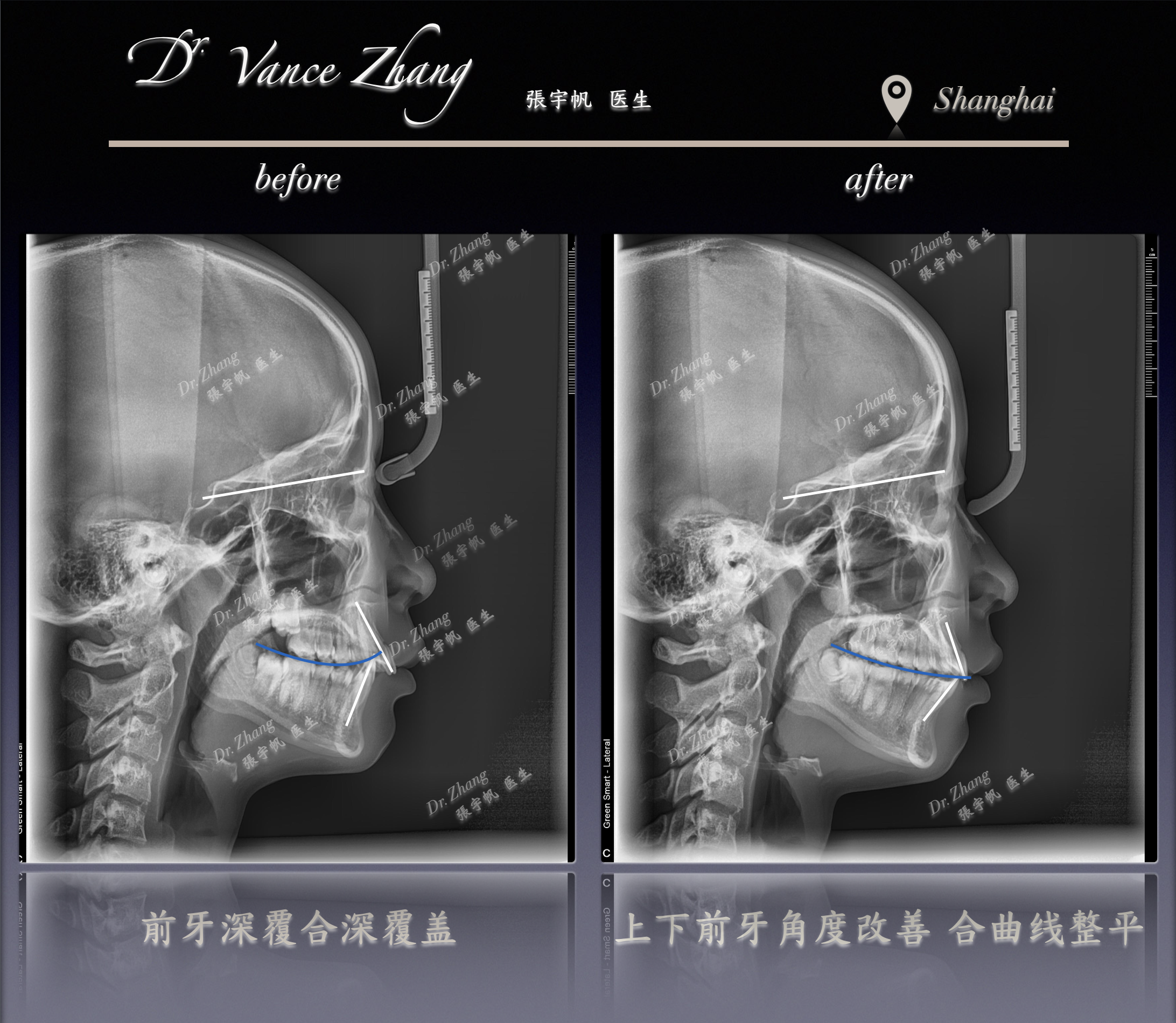 生长发育期的矫正机会正式病例贴图15