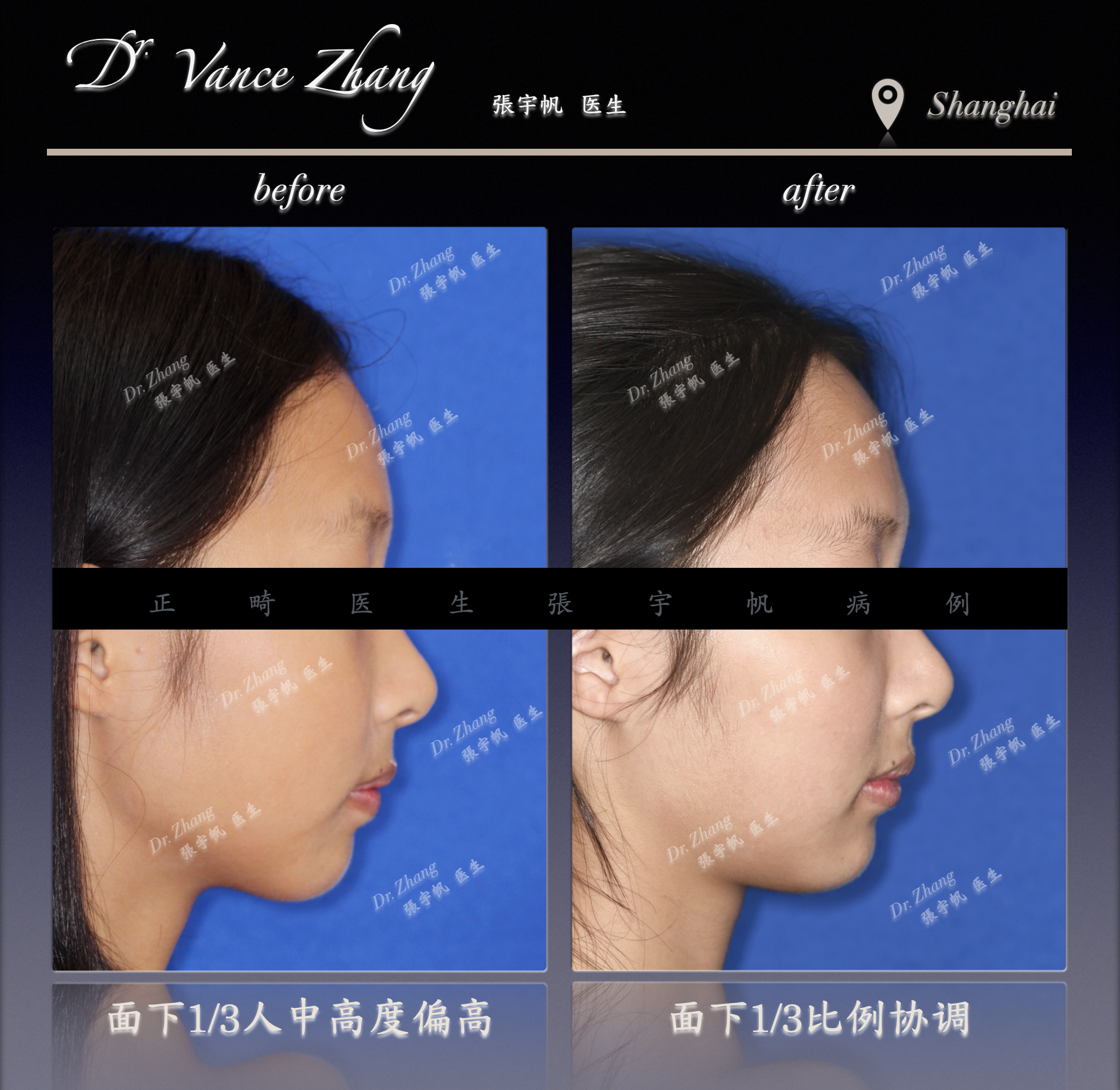 内倾型深覆合的咬合调整正式病例贴图5