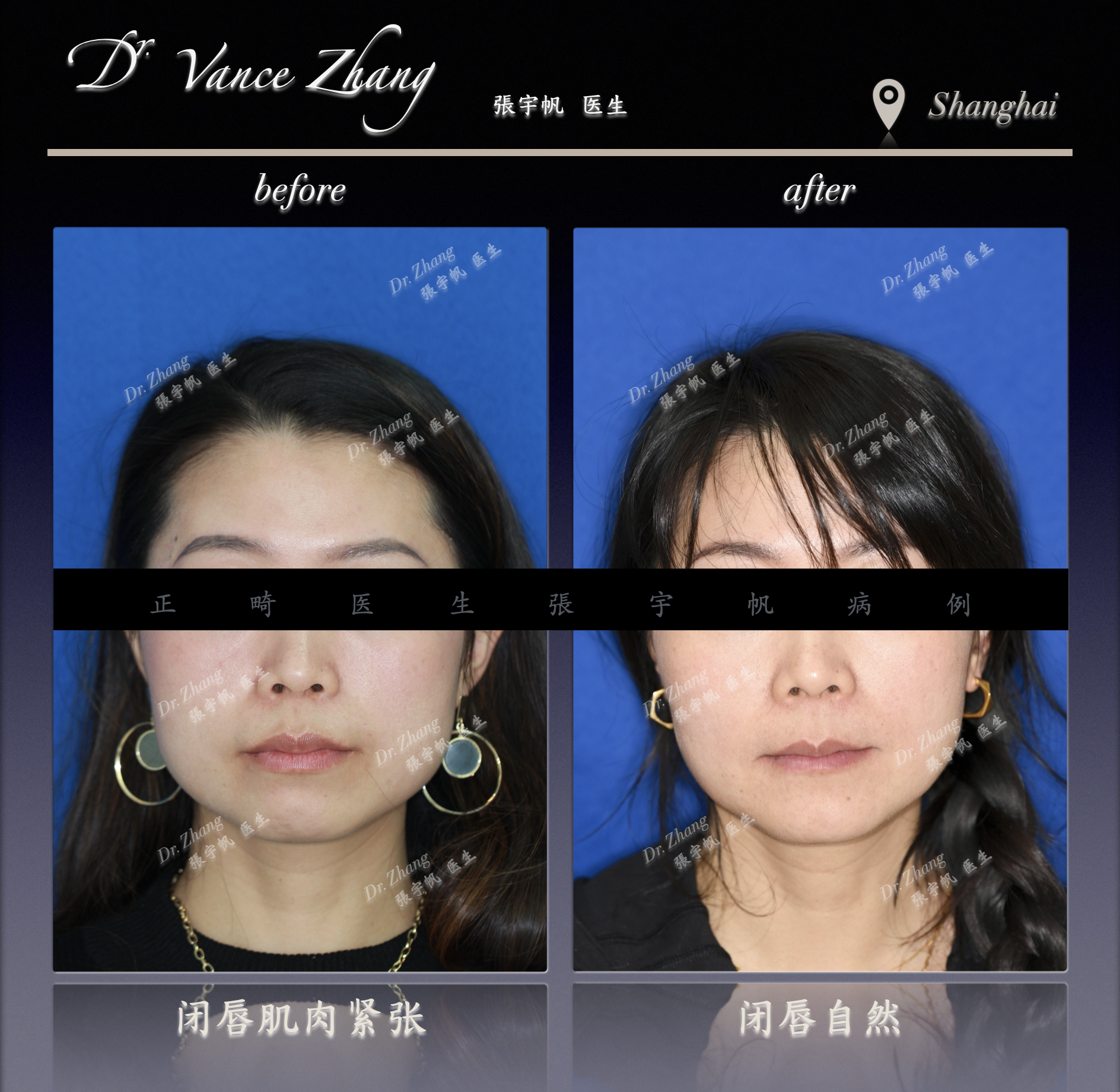 成人女性骨型双颌前突矫正正式病例贴图2