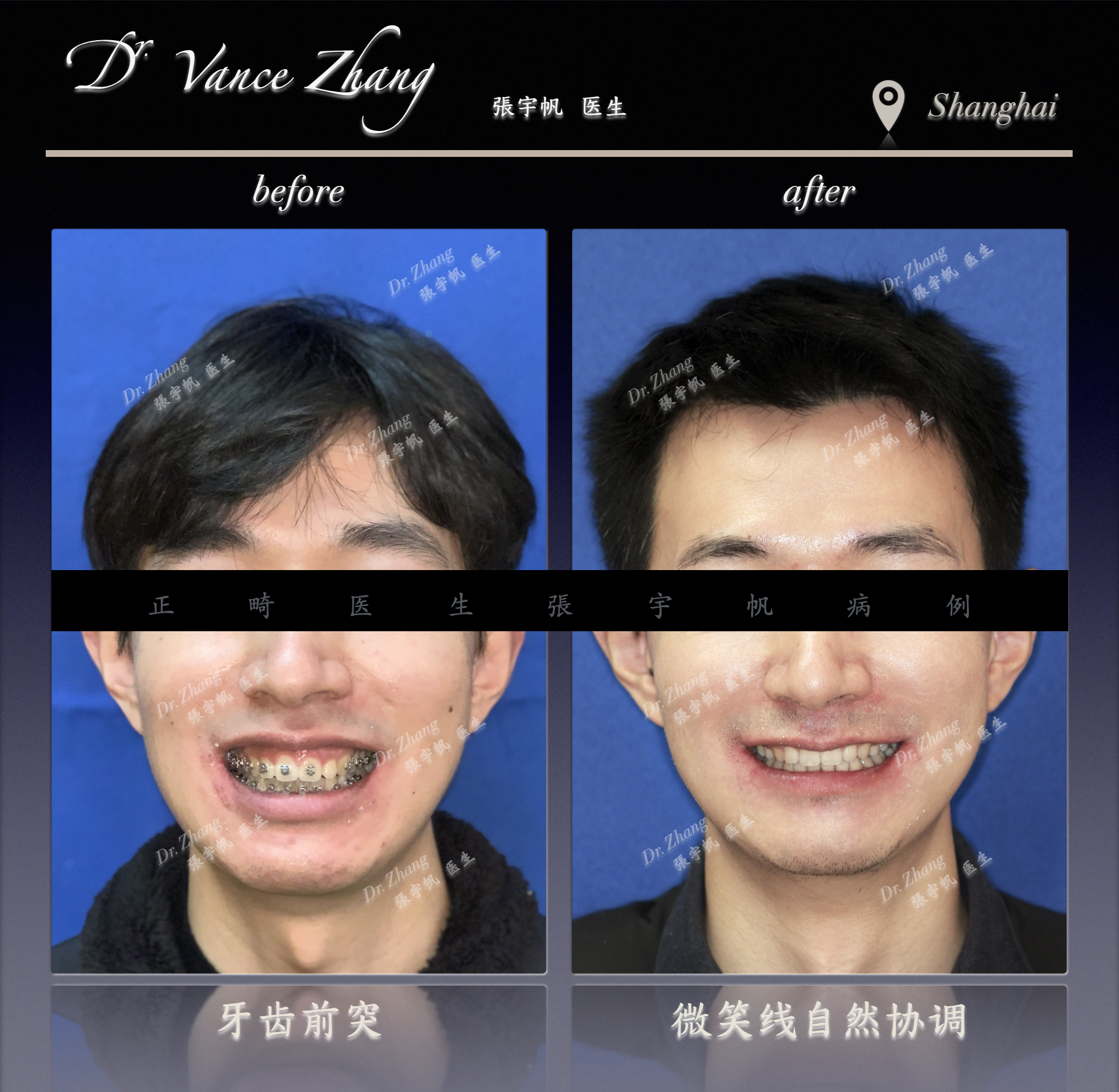 骨性嘴突二次矫正正式病例贴图3