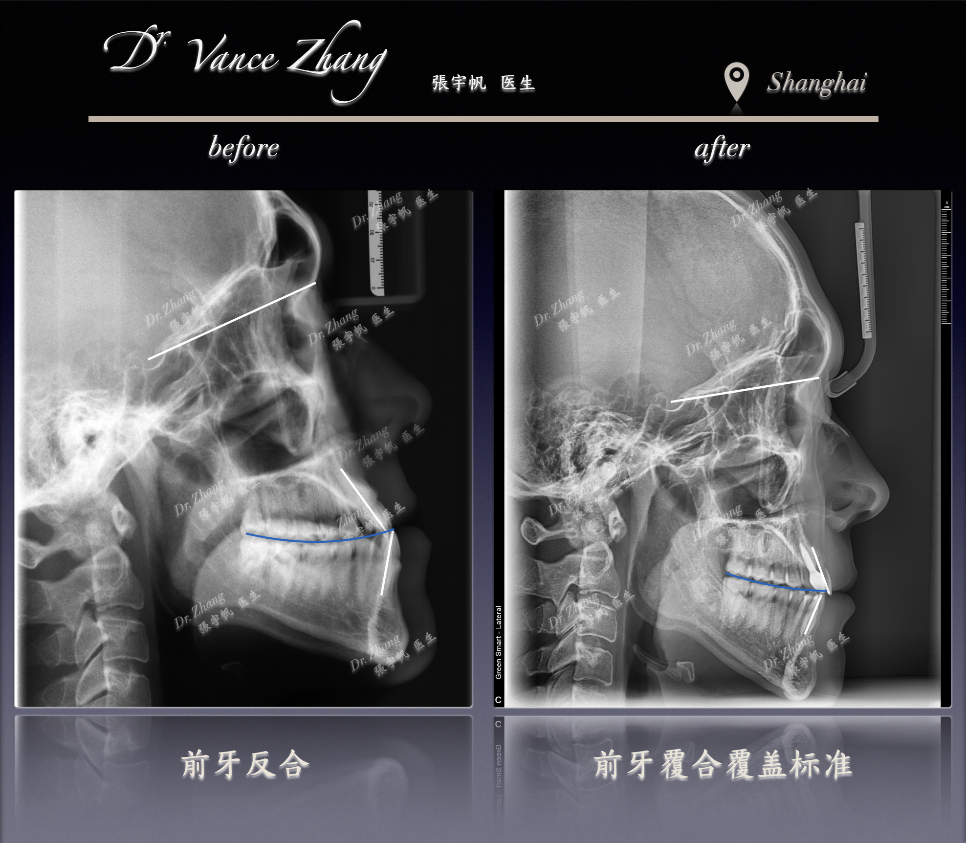 III类伴上前牙缺失正畸-种植正式病例贴图15