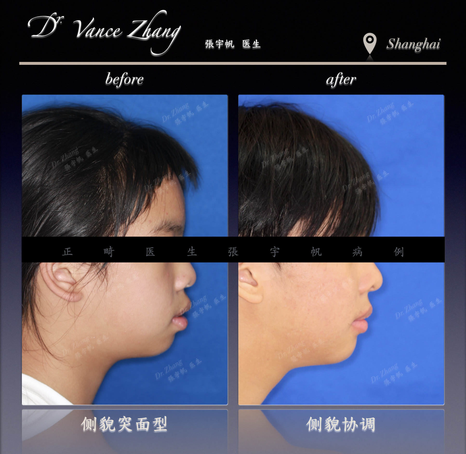 青少年嘴突的拔牙矫正正式病例贴图5