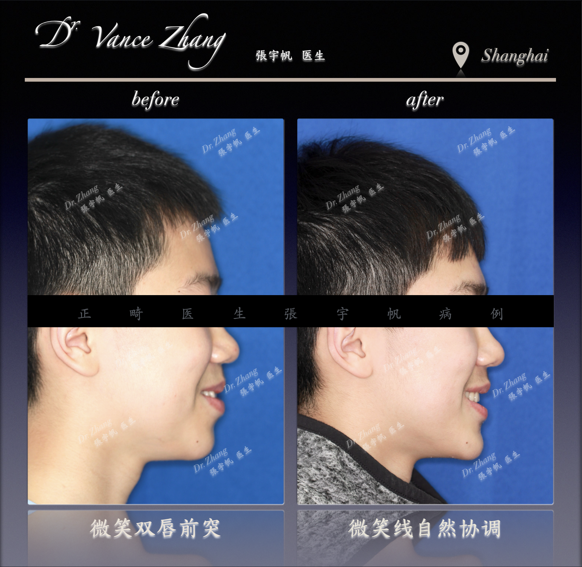 青少年Ⅲ类错𬌗矫治正式病例贴图6