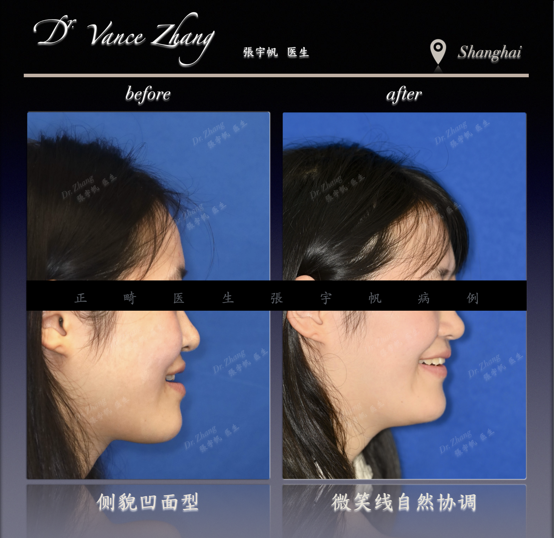 重度骨性III类的非手术改善正式病例贴图6