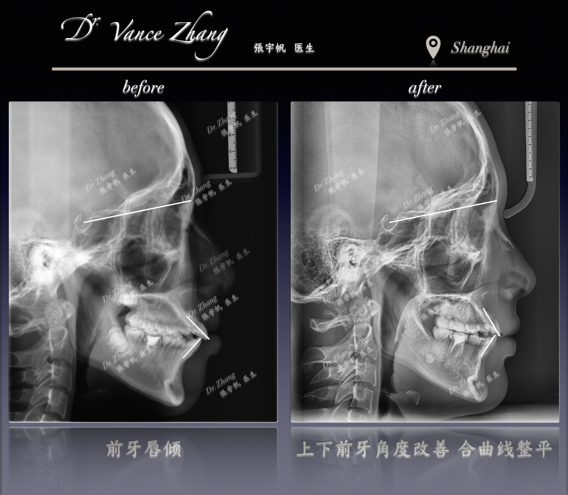 牙齿前突改善：美观与安全的平衡正式病例贴图15