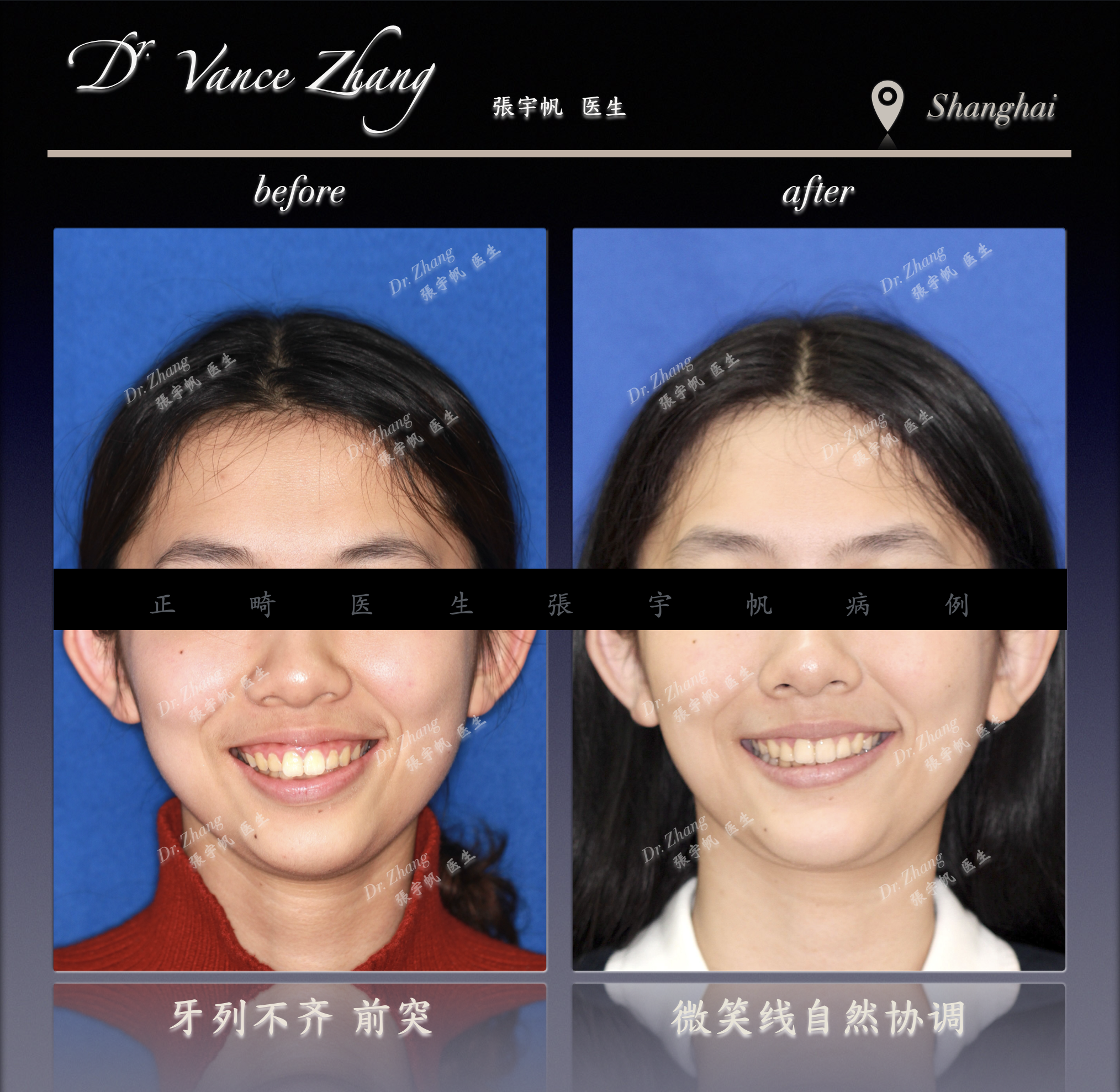 从嘴突到自然微笑正式病例贴图3