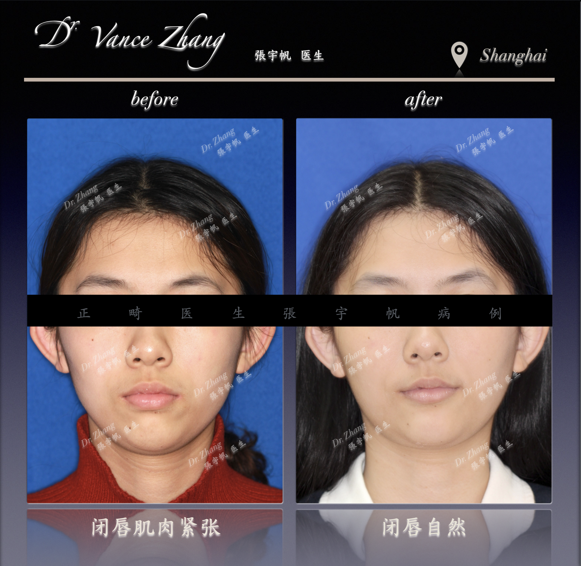 从嘴突到自然微笑正式病例贴图2