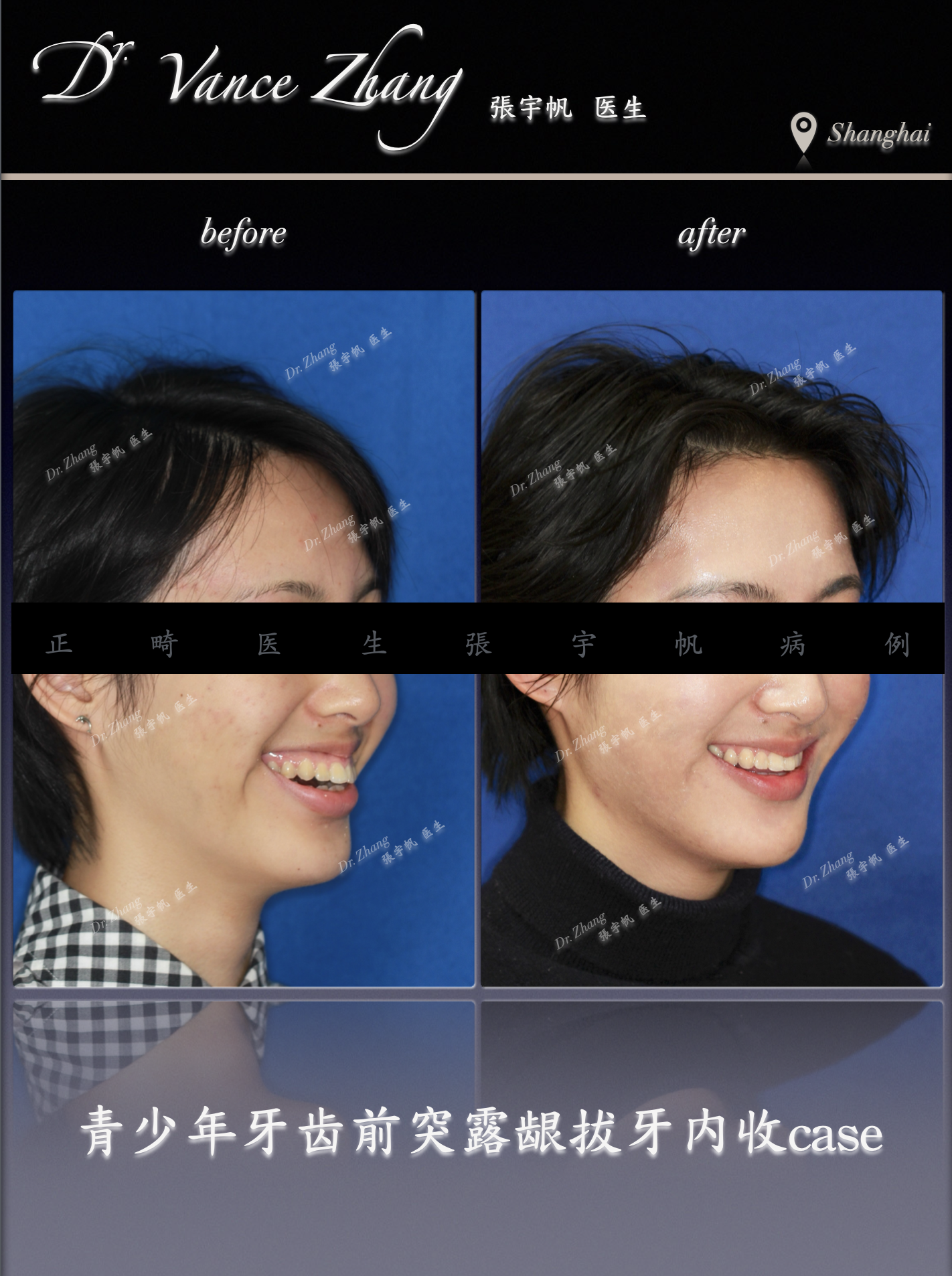 牙齿前突改善：美观与安全的平衡正式病例贴图1