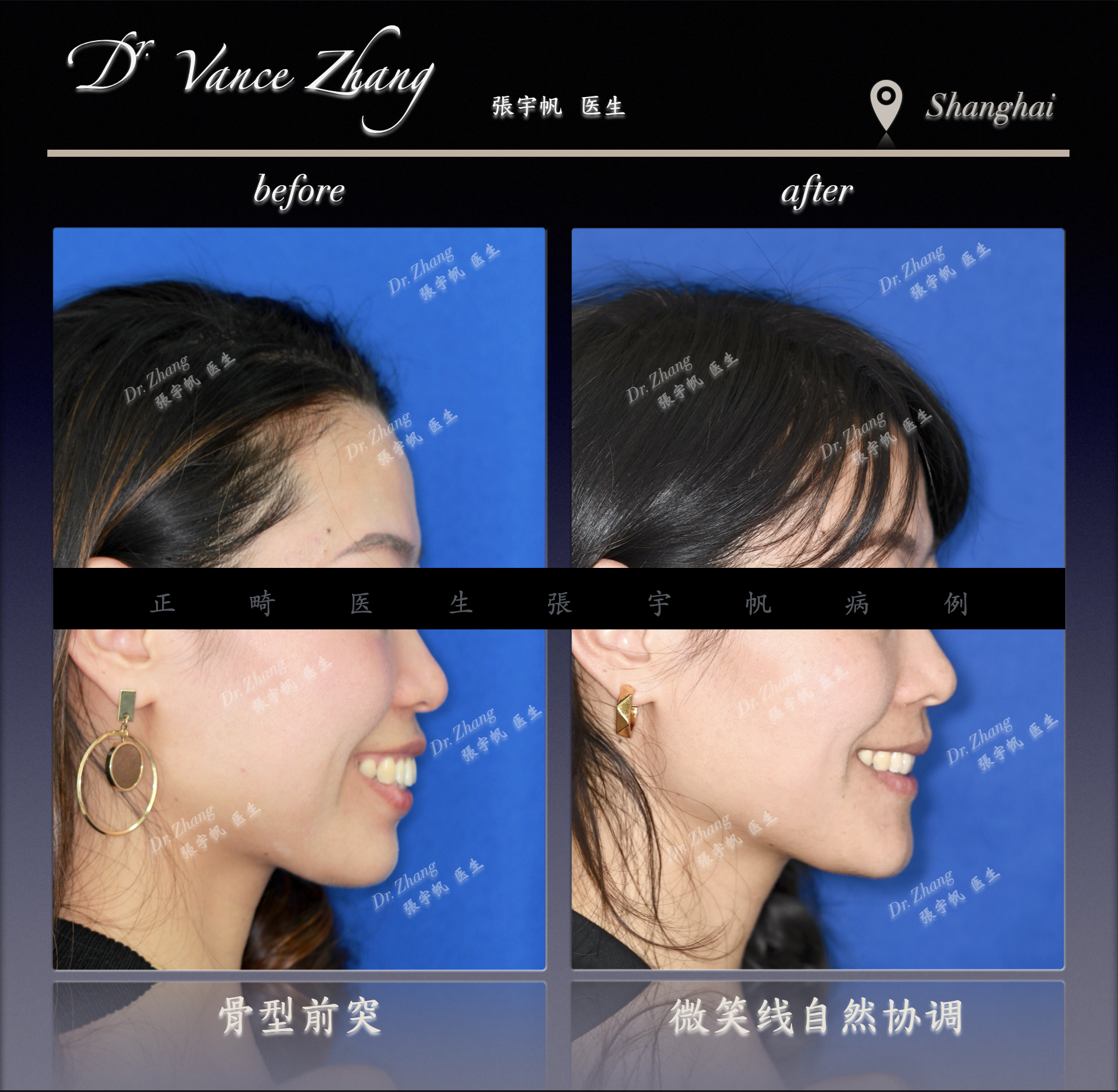 成人女性骨型双颌前突矫正正式病例贴图6