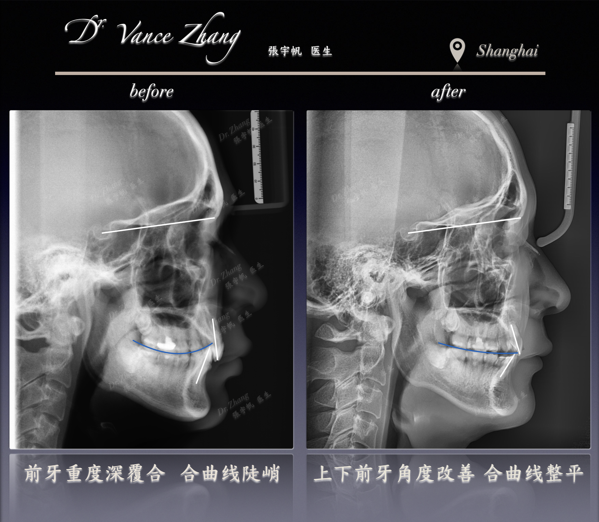 从重度深覆𬌗到健康咬合正式病例贴图15