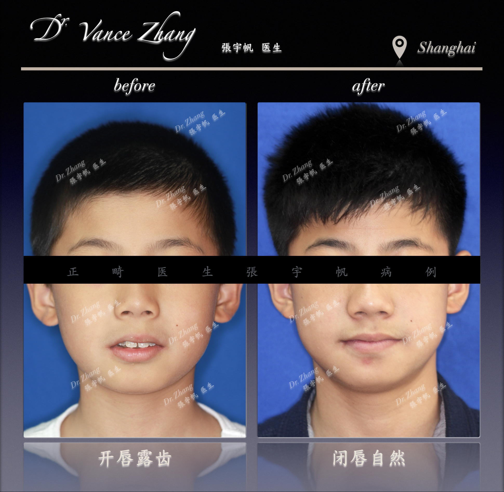 颜面发育管理的意义正式病例贴图2
