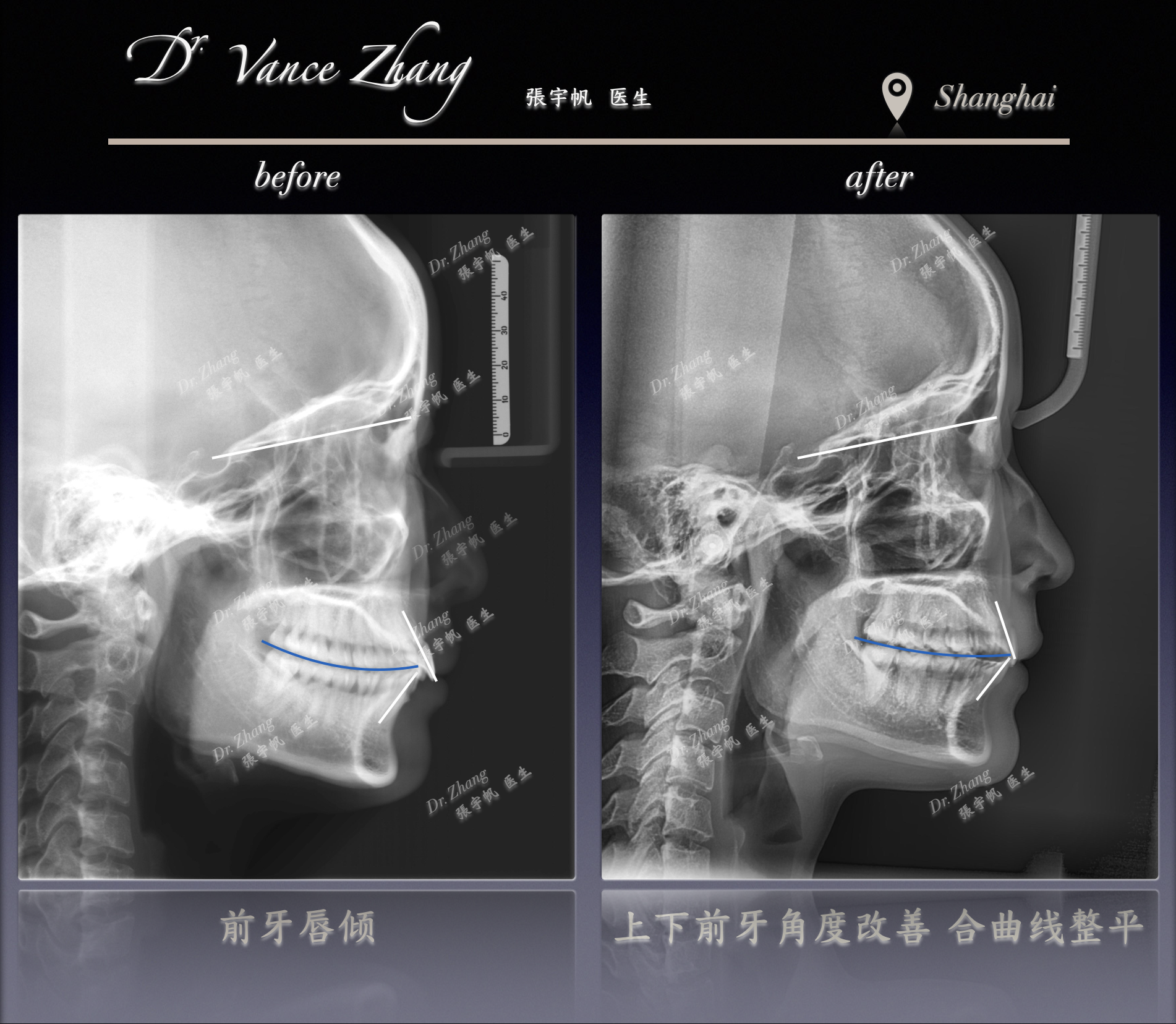 不拔牙之外的另一种选择正式病例贴图15