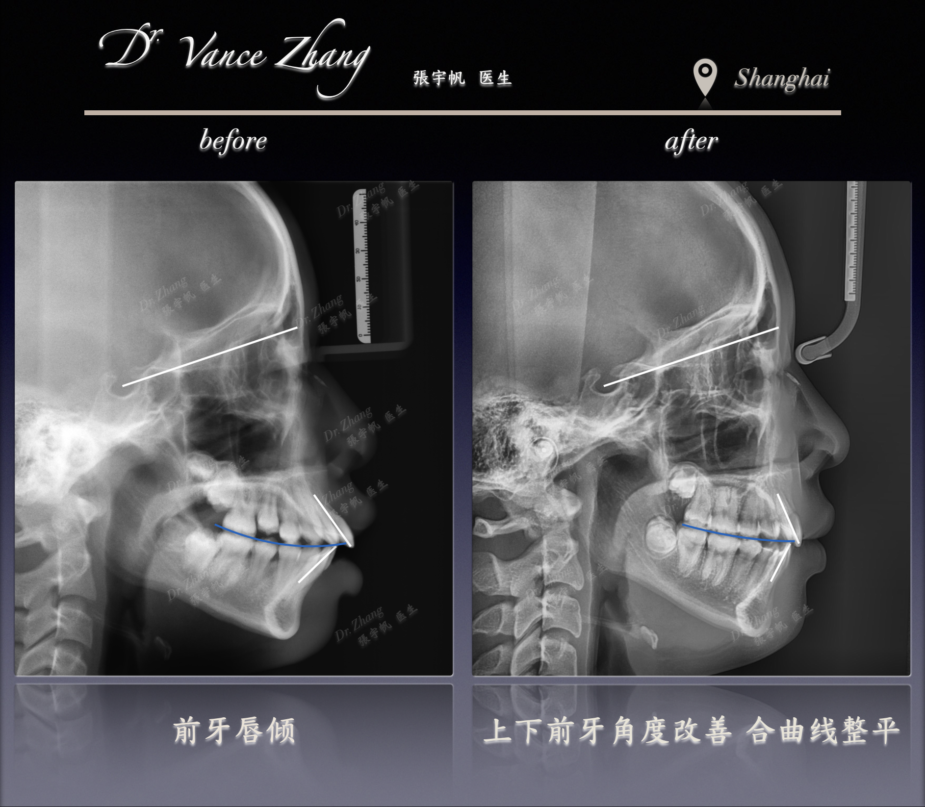 青少年嘴突的拔牙矫正正式病例贴图15