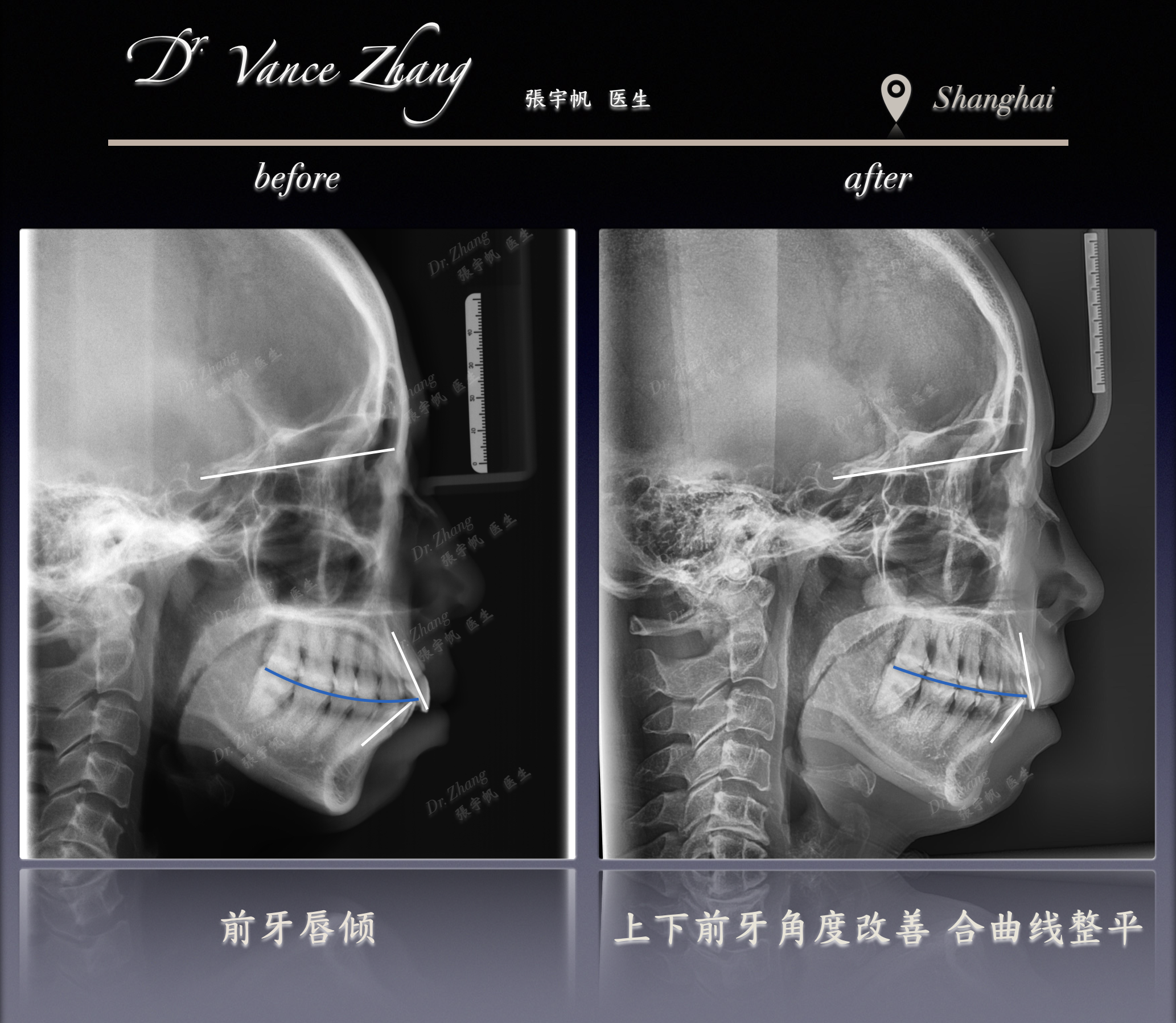 成人牙缝与黑三角的隐形矫正正式病例贴图15