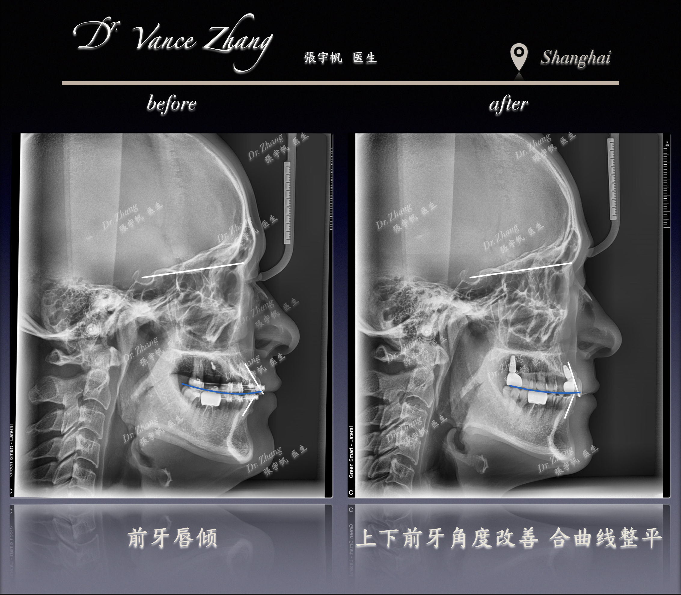 缺牙修复前的正畸规划正式病例贴图15
