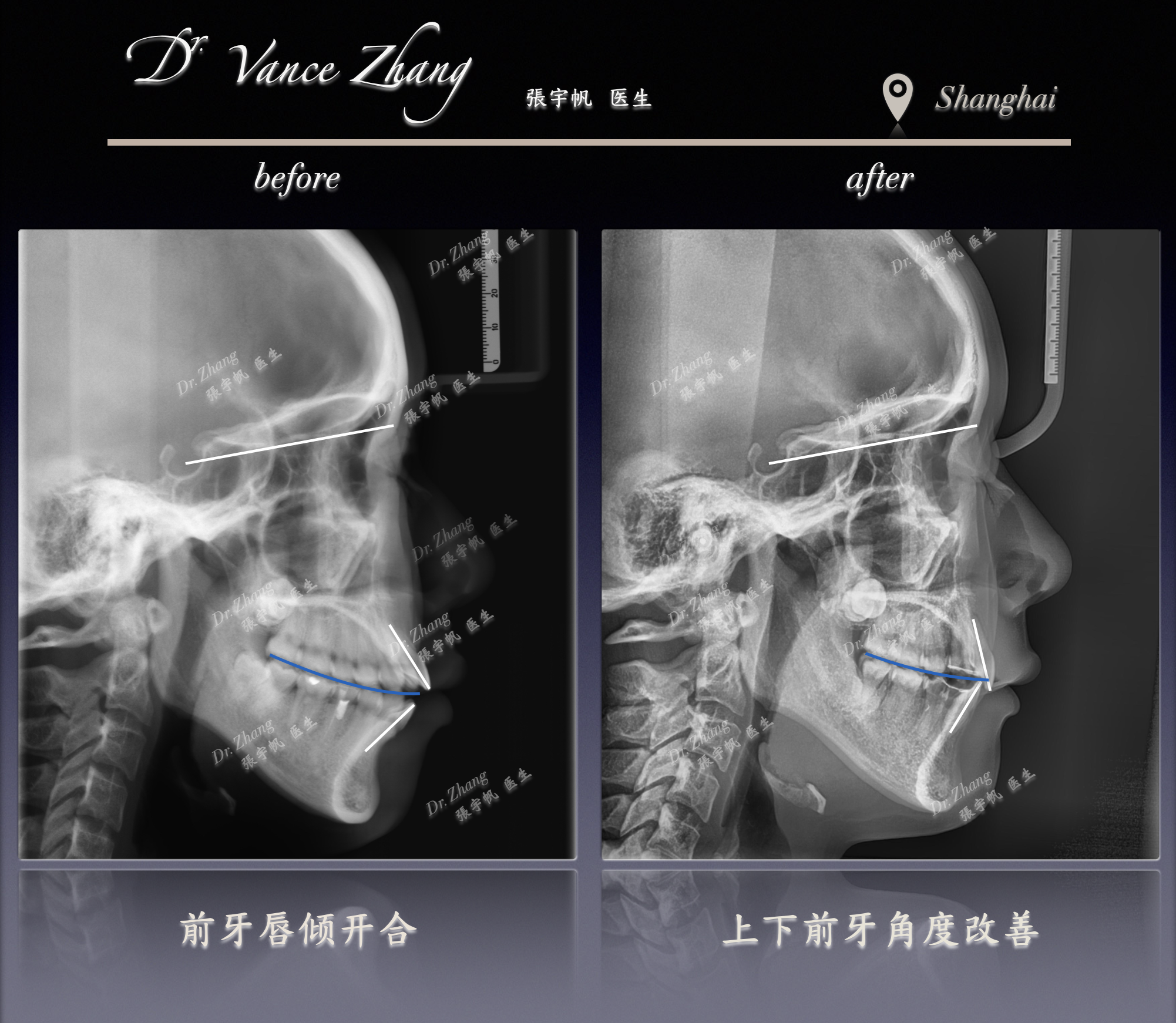 从前牙开𬌗到自信微笑正式病例贴图15
