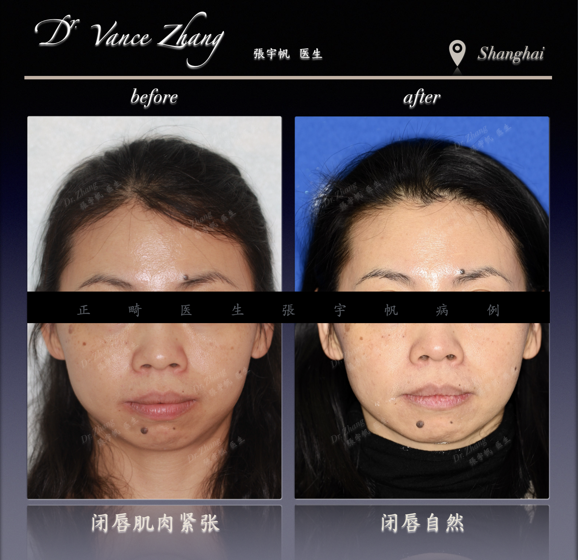成人牙缝与黑三角的隐形矫正正式病例贴图2
