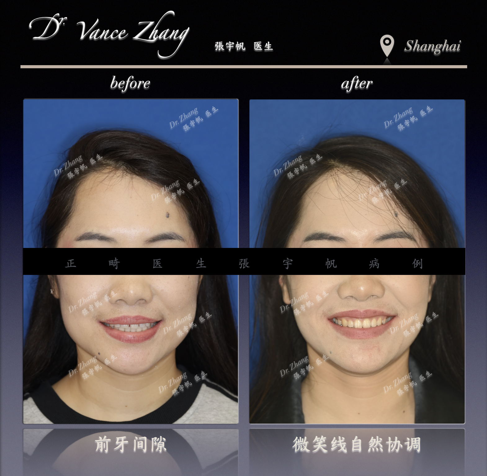 成人invisalign隐形矫正关闭牙缝正式病例贴图3