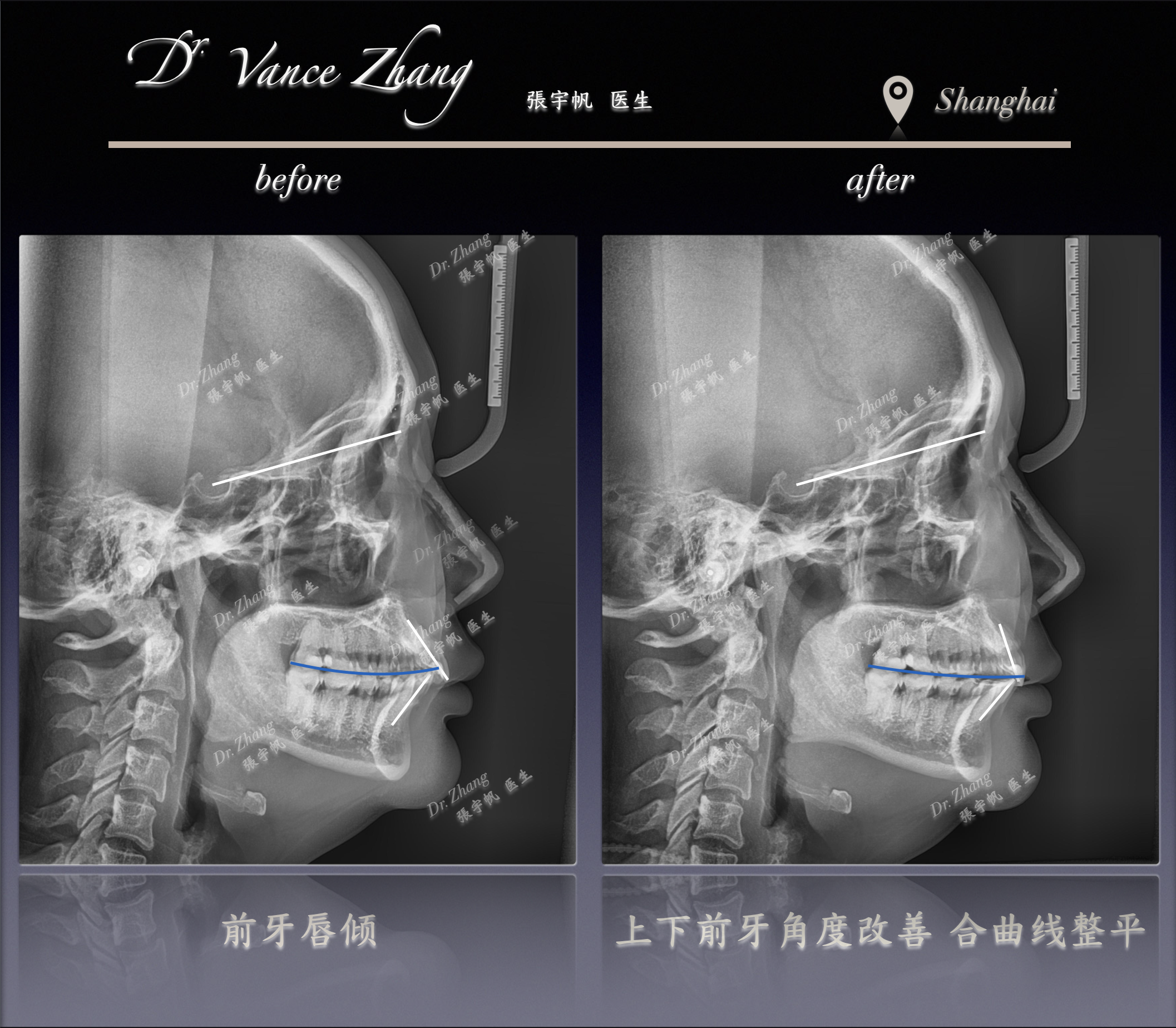轻度拥挤的非拔牙方案正式病例贴图15