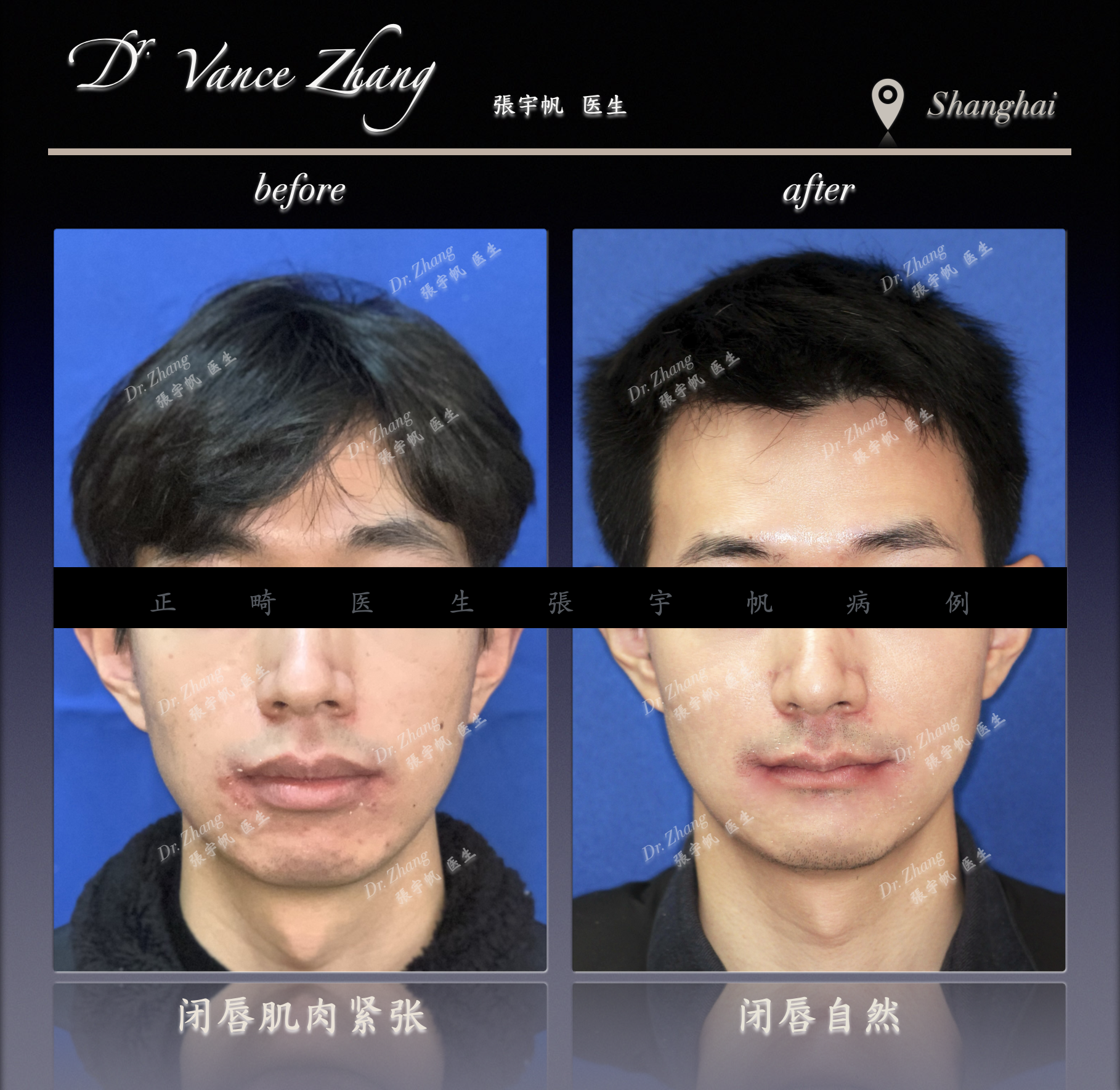 骨性嘴突二次矫正正式病例贴图2