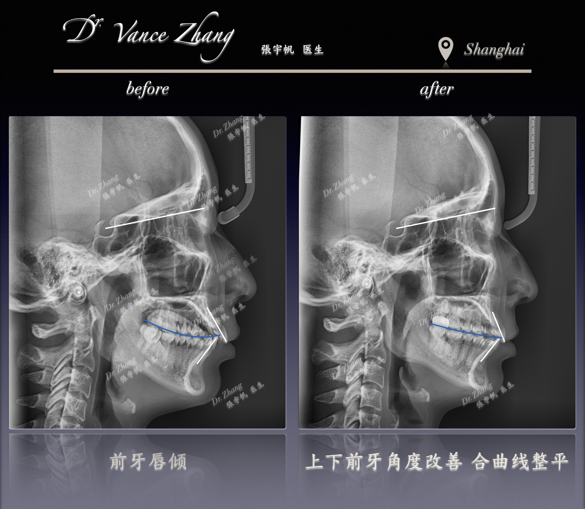 一位骨科医生的正畸治疗正式病例贴图15