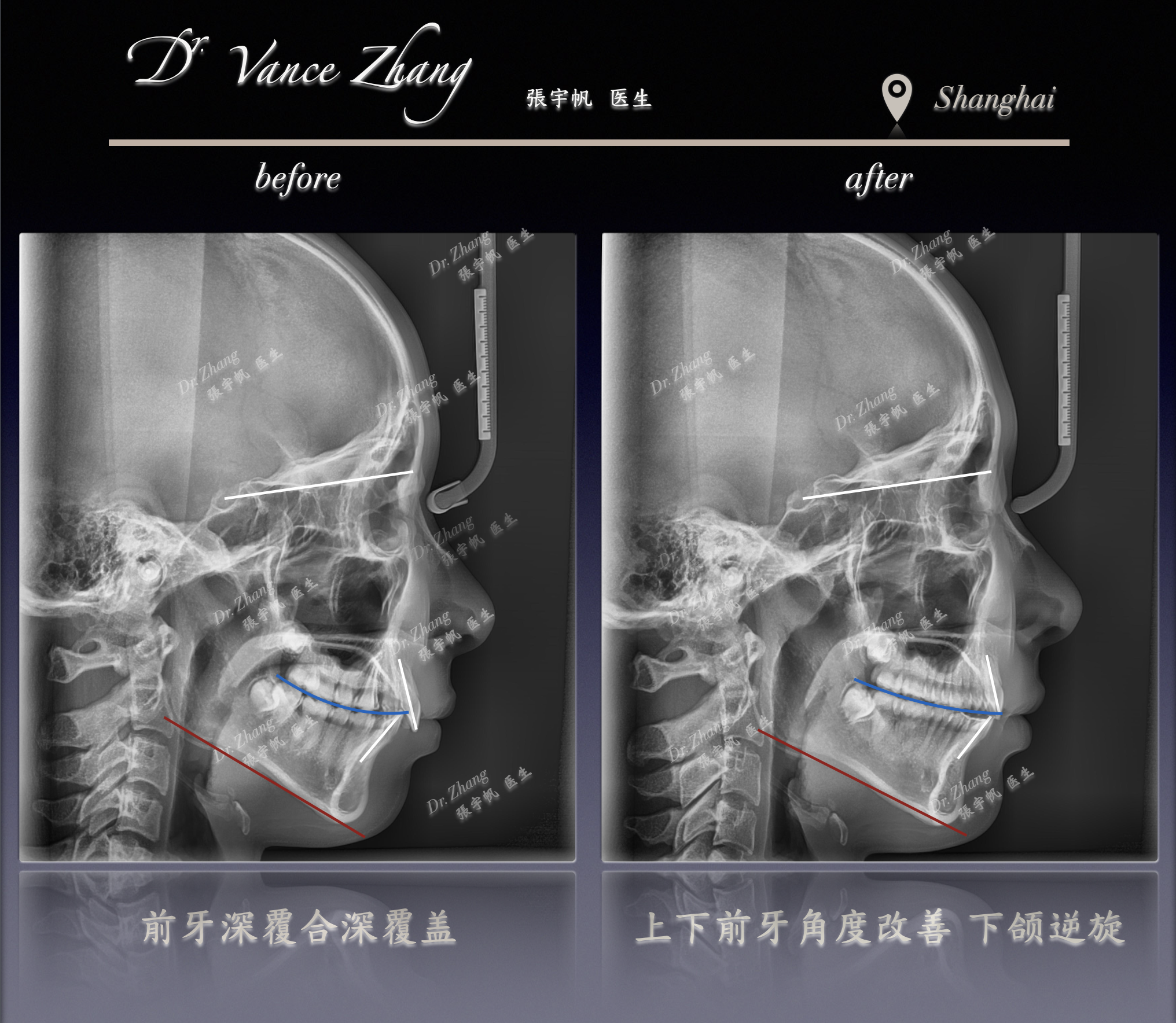 内倾型深覆合的咬合调整正式病例贴图15
