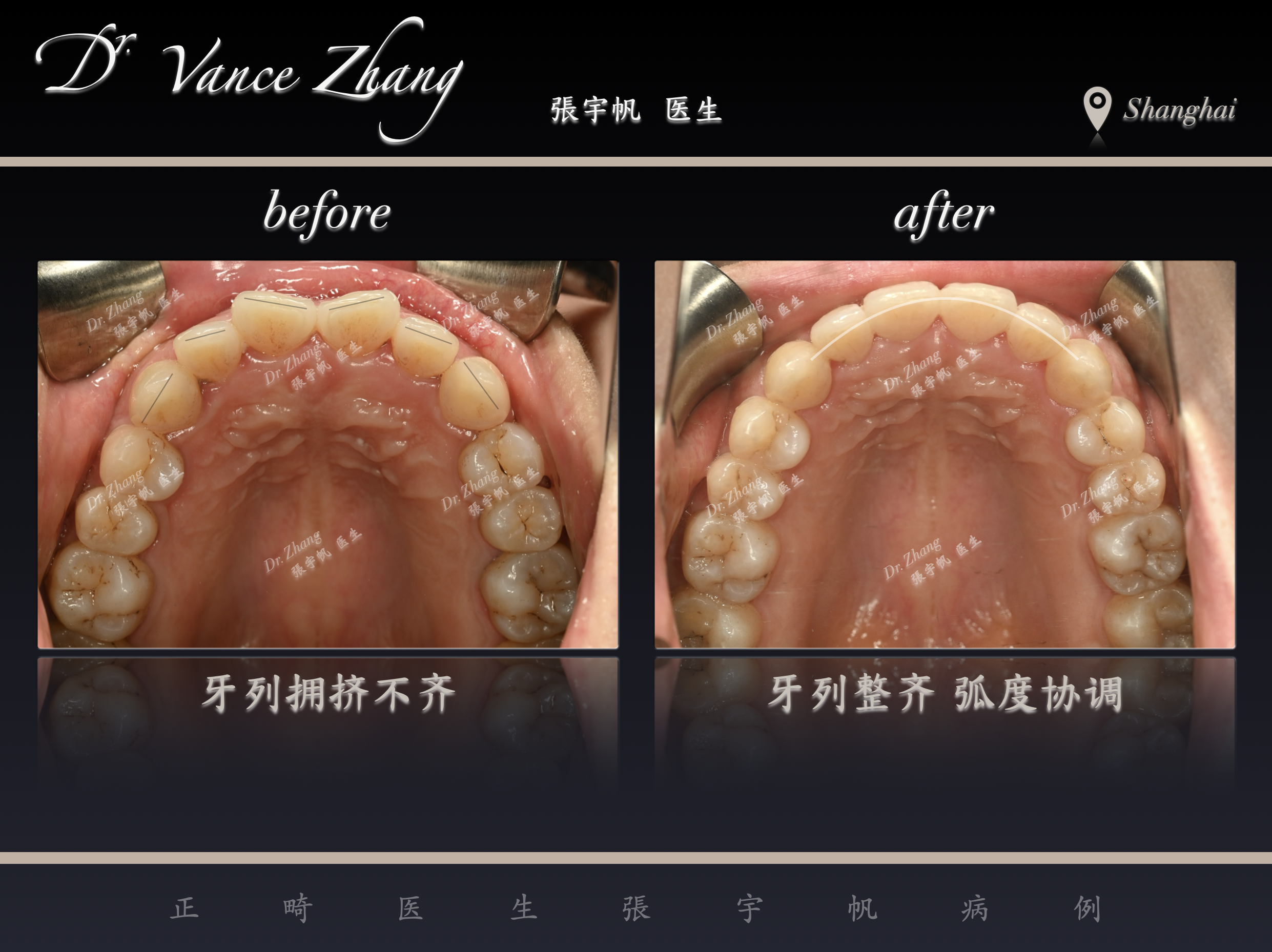 远移磨牙的临床意义正式病例贴图13
