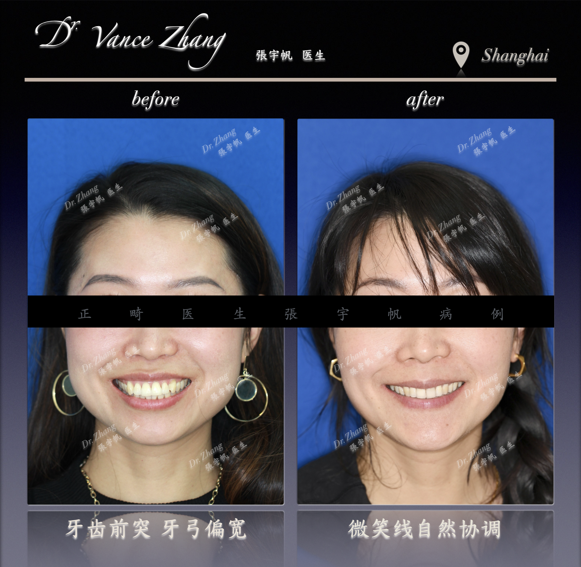 成人女性骨型双颌前突矫正正式病例贴图3