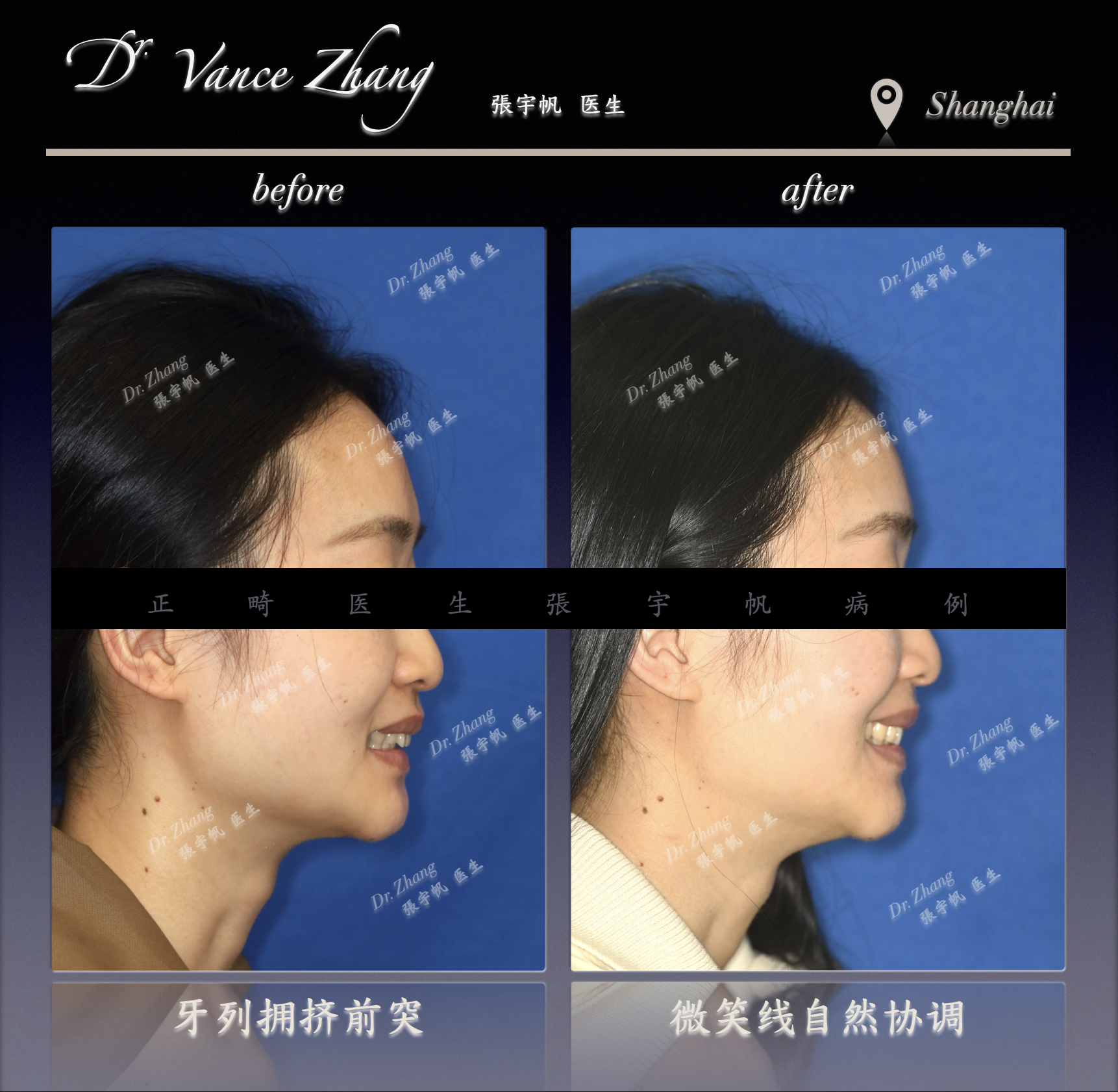 隐形矫正单侧推磨牙向后正式病例贴图5