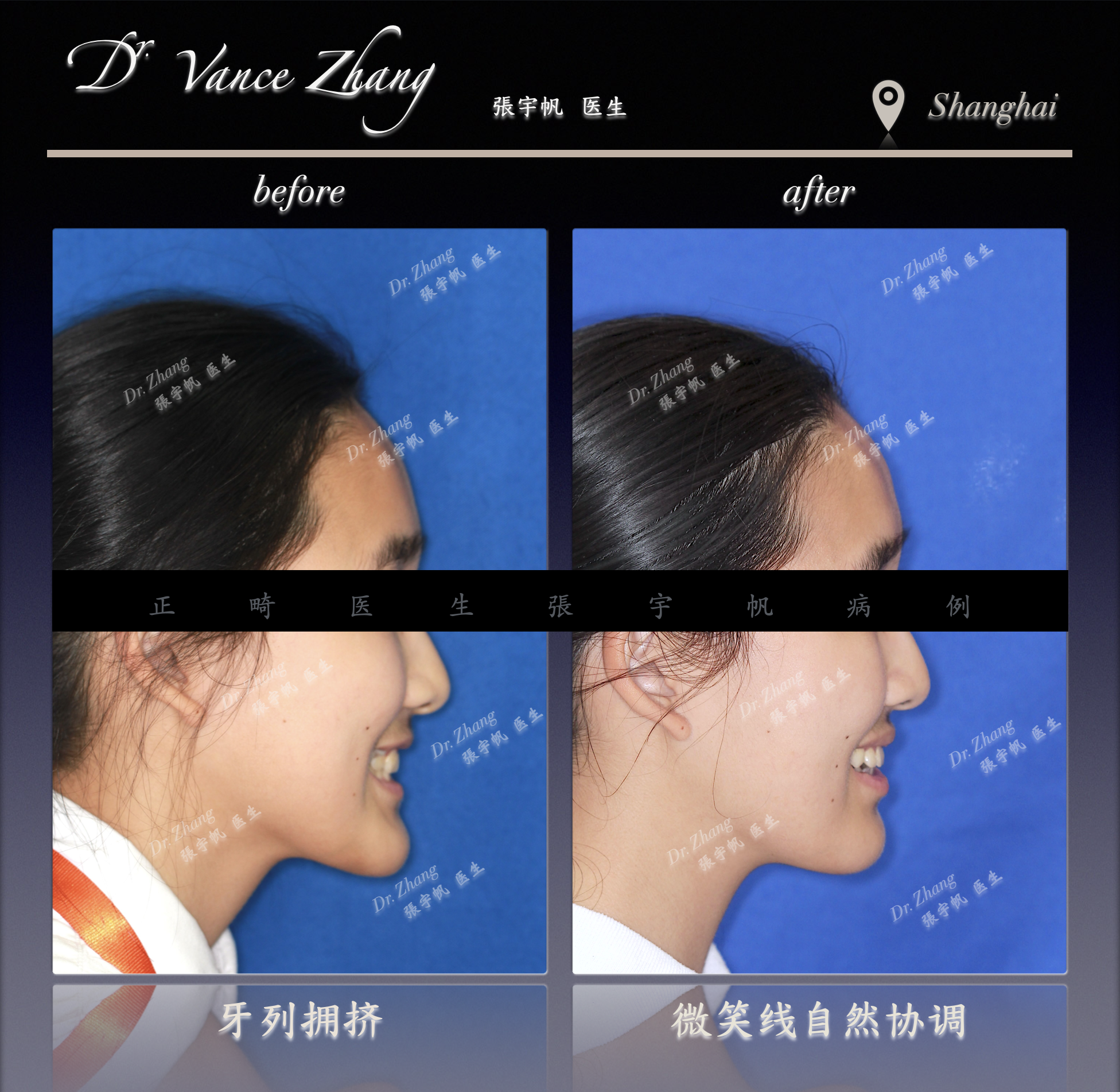 中重度拥挤的非拔牙矫正正式病例贴图6
