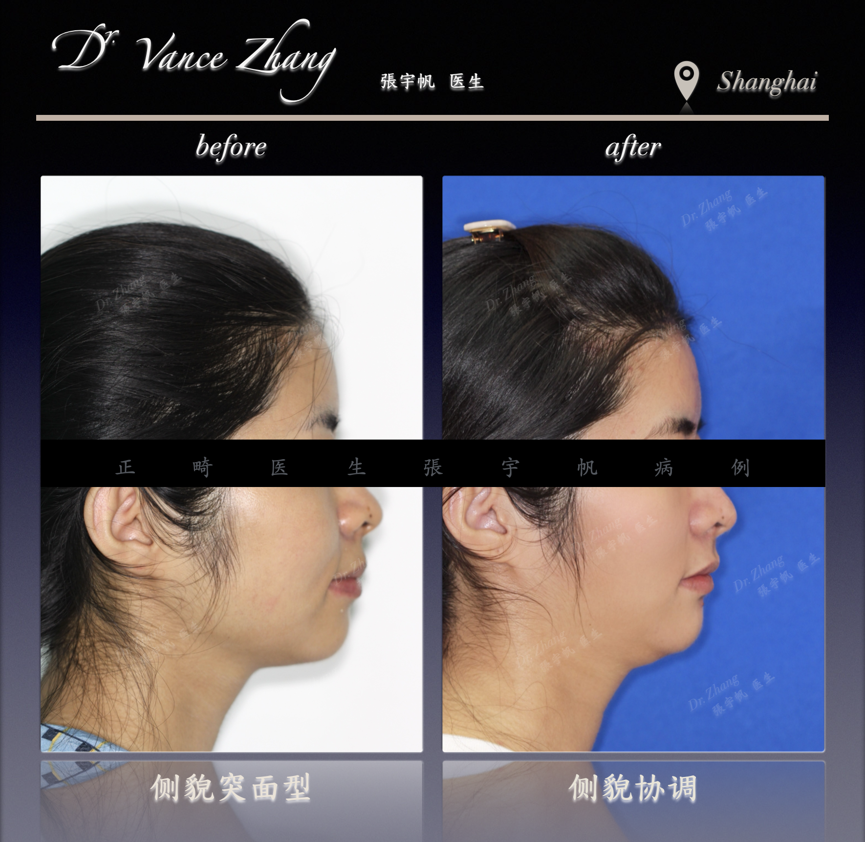 骨性Ⅱ类嘴突的拔牙内收正式病例贴图5