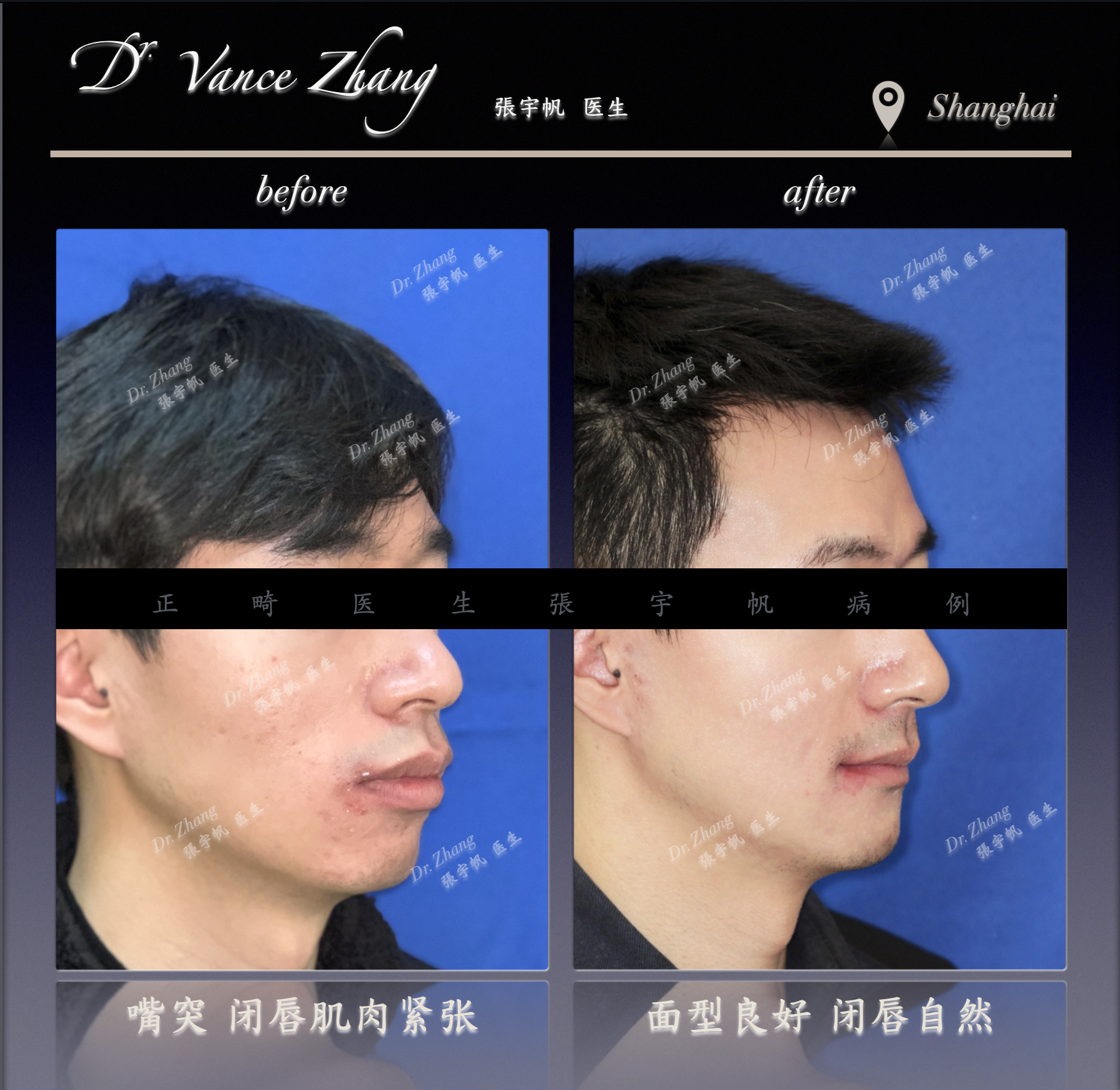 骨性嘴突二次矫正正式病例贴图4