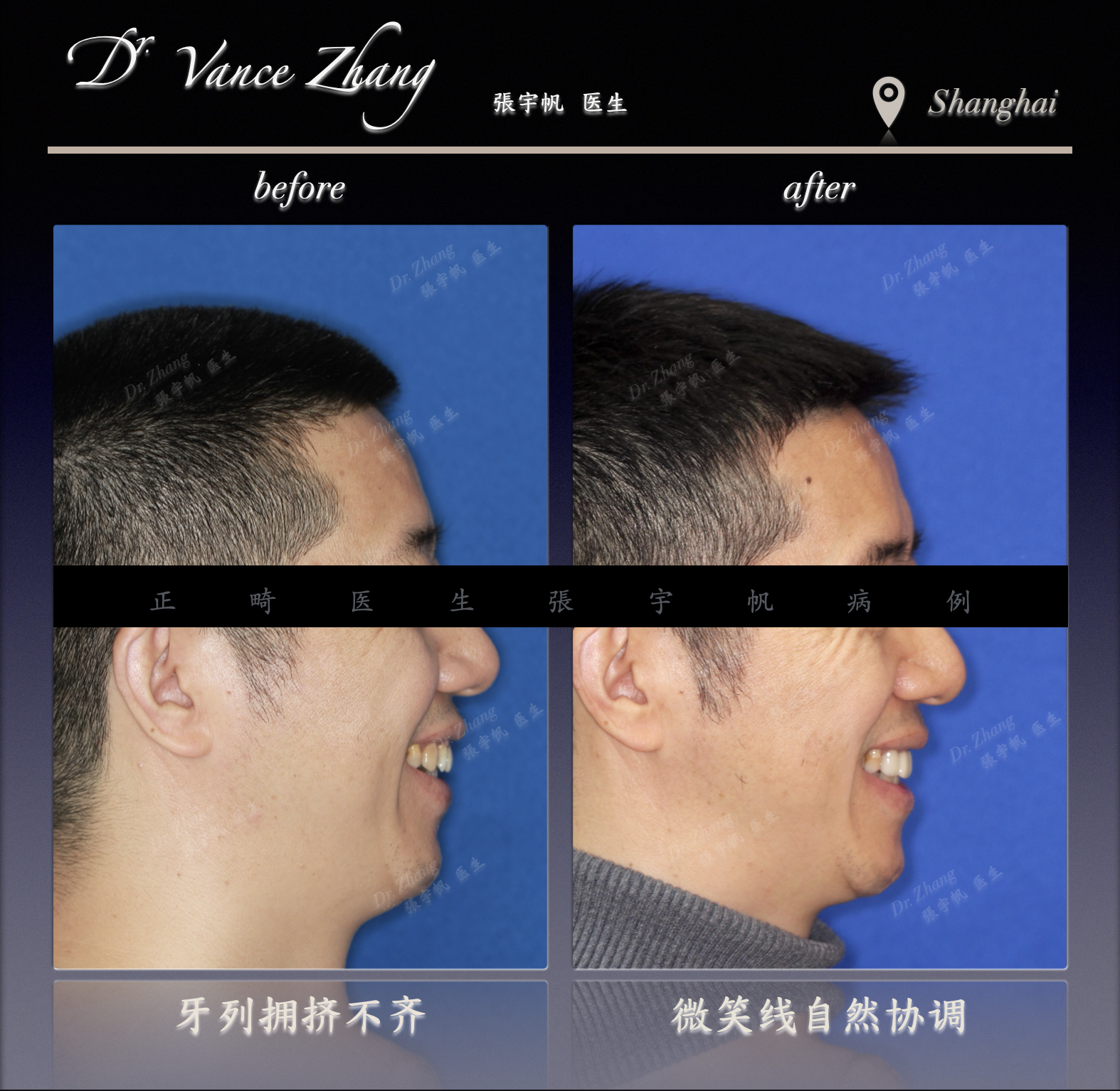 拔除下7后近移智齿替代正式病例贴图6