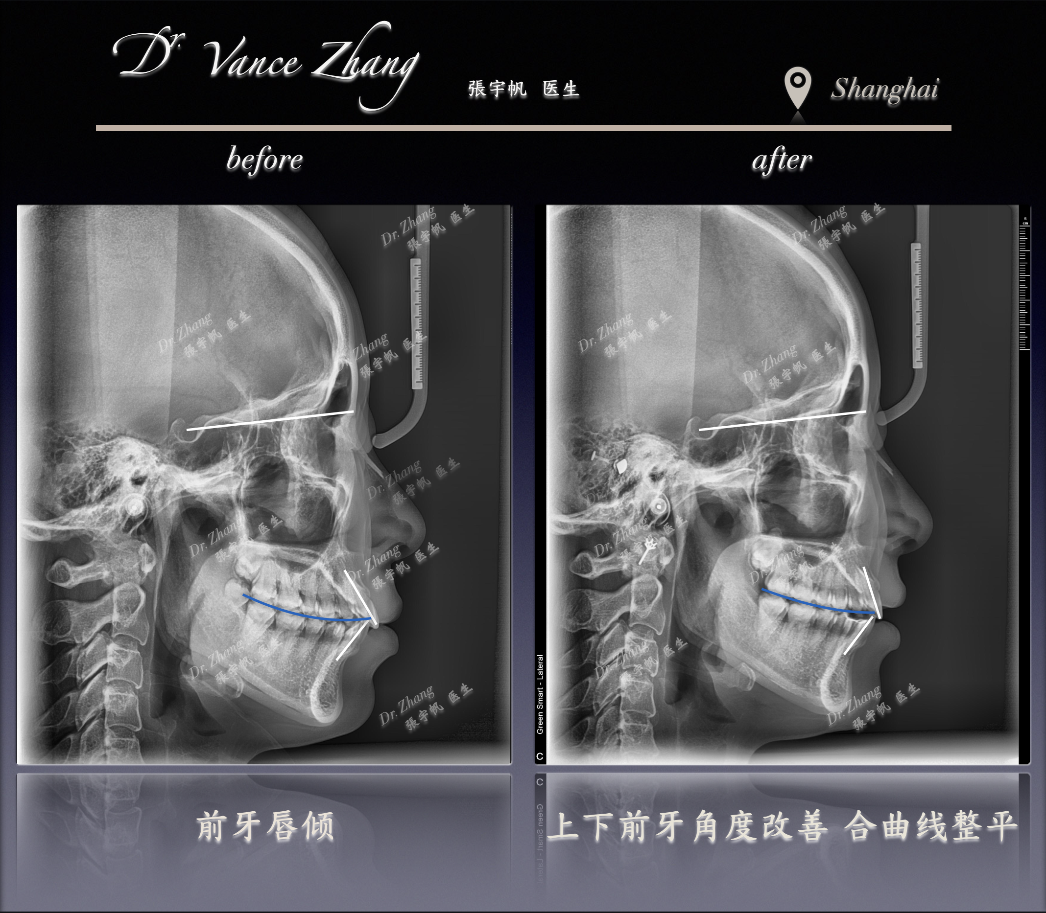远移磨牙的临床意义正式病例贴图15