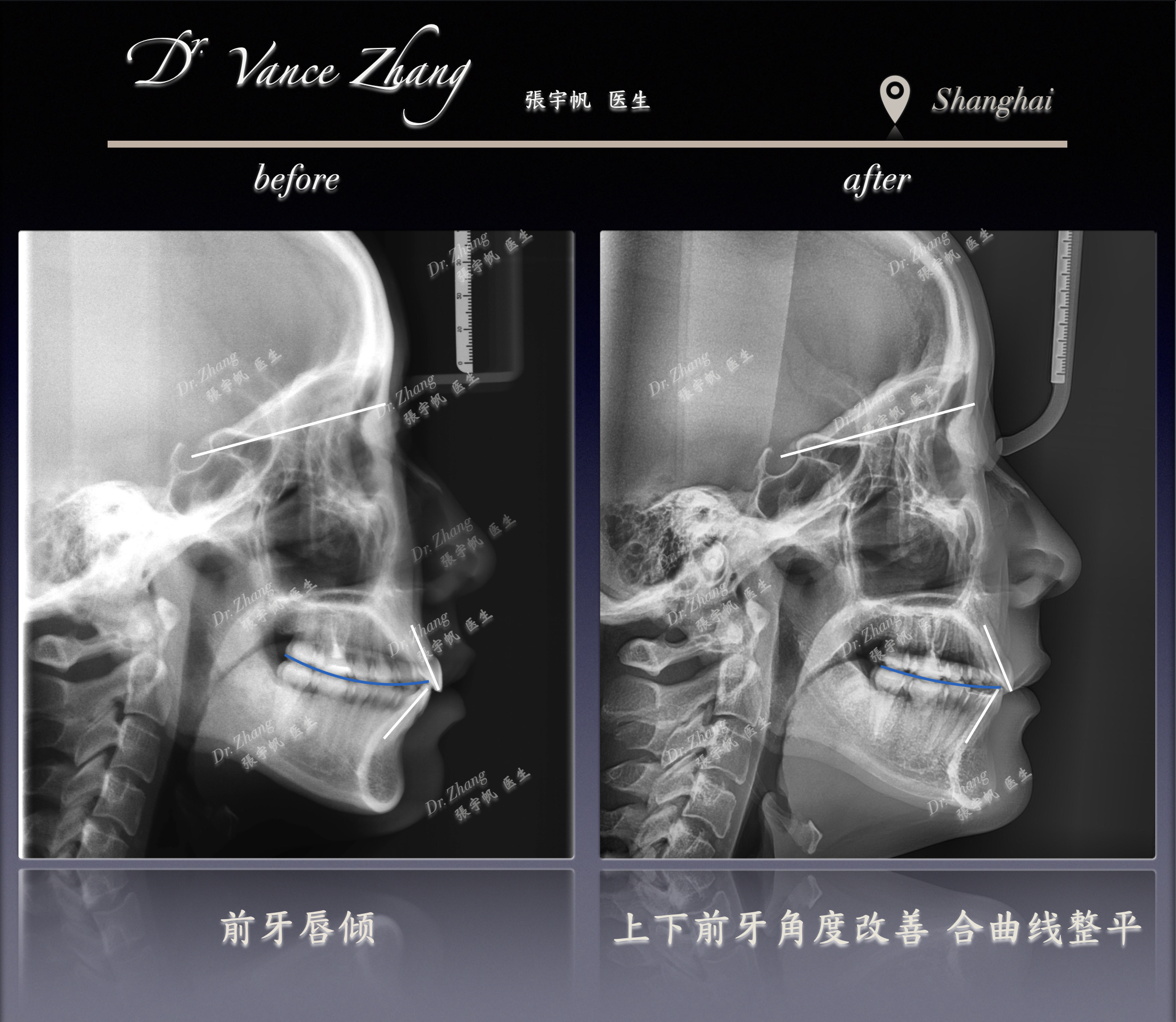 从微突到自然微笑正式病例贴图15