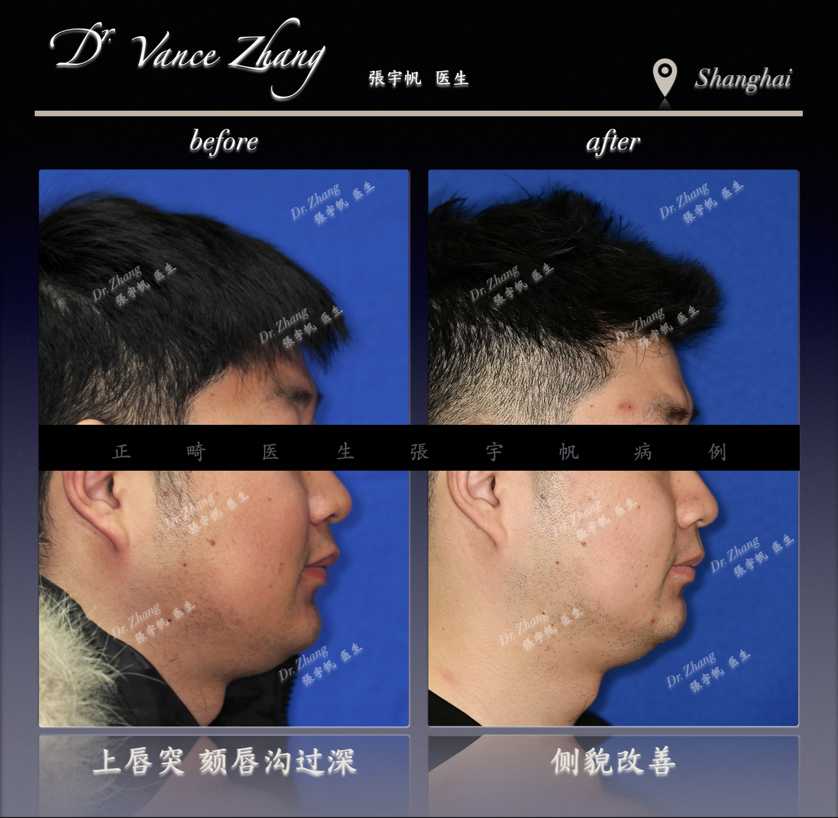 Ⅱ类错𬌗的支抗钉辅助磨牙远移正式病例贴图5