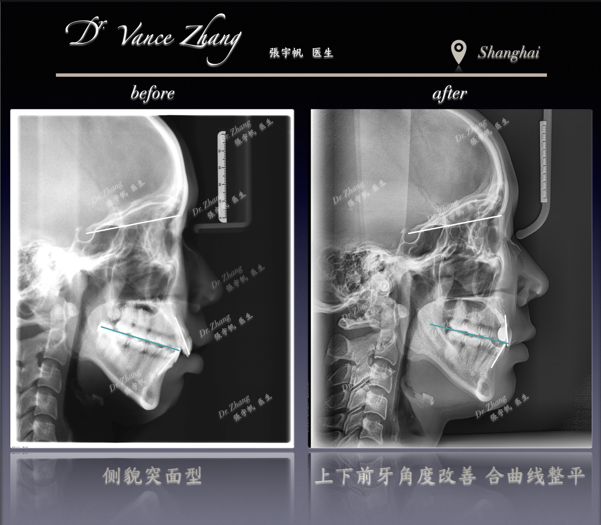 正畸与种植联合治疗正式病例贴图15
