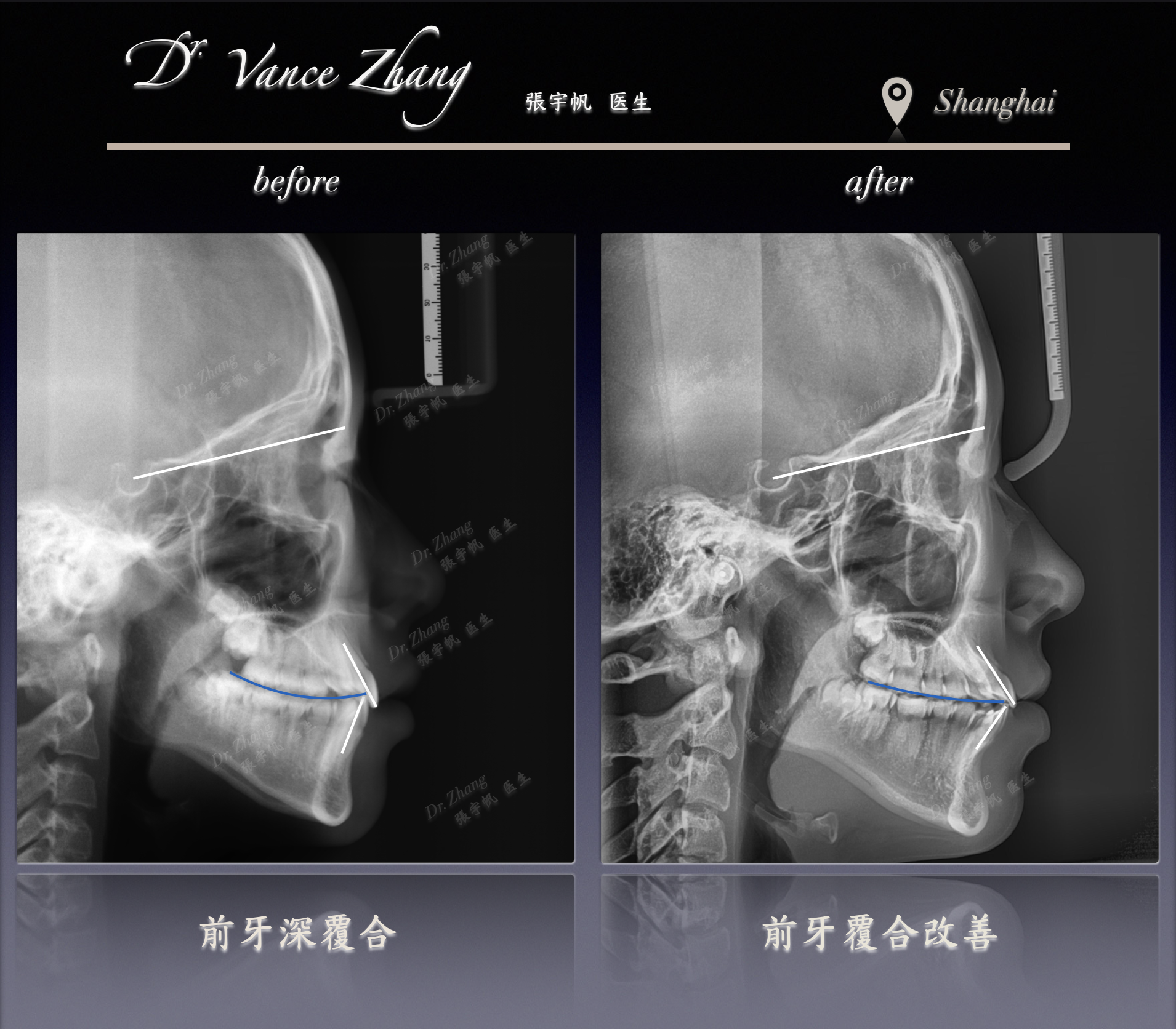 牙列拥挤与侧貌平衡正式病例贴图15